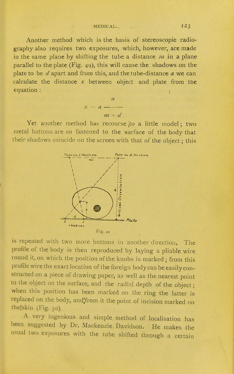 Another method which is the basis of stereoscopic radio- graphy also requires two exposures, which, however, are made in the same plane by shifting the tube a distance in in a plane parallel to the plate (Fig. 49), this will cause the shadows on the plate to be d apart and from this, and the tube-distance a we can calculate the distance x between object and plate from the equation: , a m + d Yet another method has recourse jto a little model; two metal buttons are so fastened to the surface of the body that their shadows coincide on the screen with that of the object; this 71t»e i.n.I.PcUtl<ln, n 1- 7V6f in, X.fcutim —* Ptut, Fig- 49 is repeated with two more buttons in another direction. The profile of the body is then reproduced by laying a pliable wire round it, on which the position of the knobs is marked; from this profile wire the exact location of the foreign body can be easily con- structed on a piece of drawing paper, as well as the nearest point to the object on the surface, and the radial depth of the object; when this position has been marked on the ring the latter is replaced on the body, andjfrom it the point of incision marked on thejskin (Fig. 50). A very ingenious and simple method of localisation has been suggested by Dr. Mackenzie Davidson. He makes the usual two exposures with the tube shifted through a certain