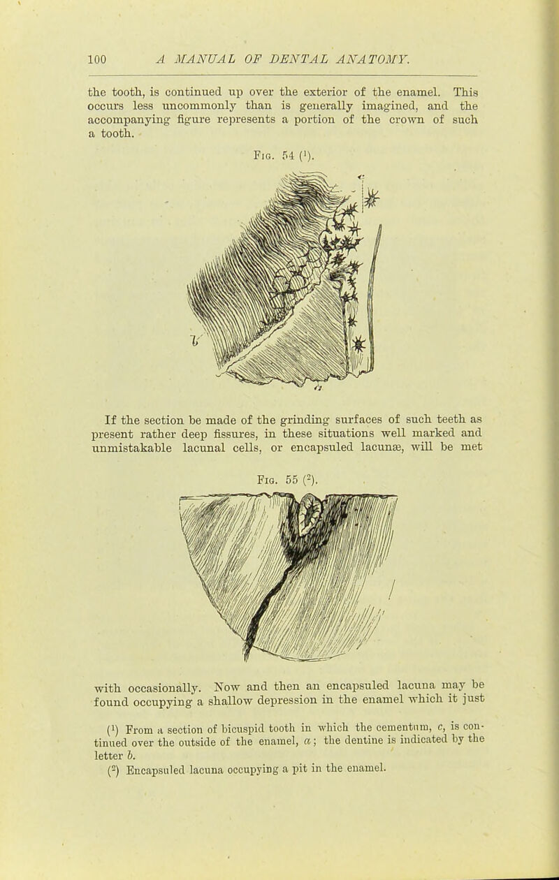 the tooth, is continued up over the exterior of the enamel. This occurs less uncommonly than is generally imagined, and the accompanying figure represents a portion of the crown of such a tooth. Fig. 54 (>). If the section be made of the grinding surfaces of such teeth as present rather deep fissures, in these situations well marked and unmistakable lacunal cells, or encax>suled lacunse, will be met Fig. 55 0. with occasionally. Now and then an encapsuled lacuna inay be found occupying a shallow depression in the enamel which it just (1) From a section of bicuspid tooth in which the cementnm, c, is con- tinued over the outside of the enamel, ct; the dentine is indicated by the letter 6. (-) Encapsuled lacuna occupying a pit in the enamel.