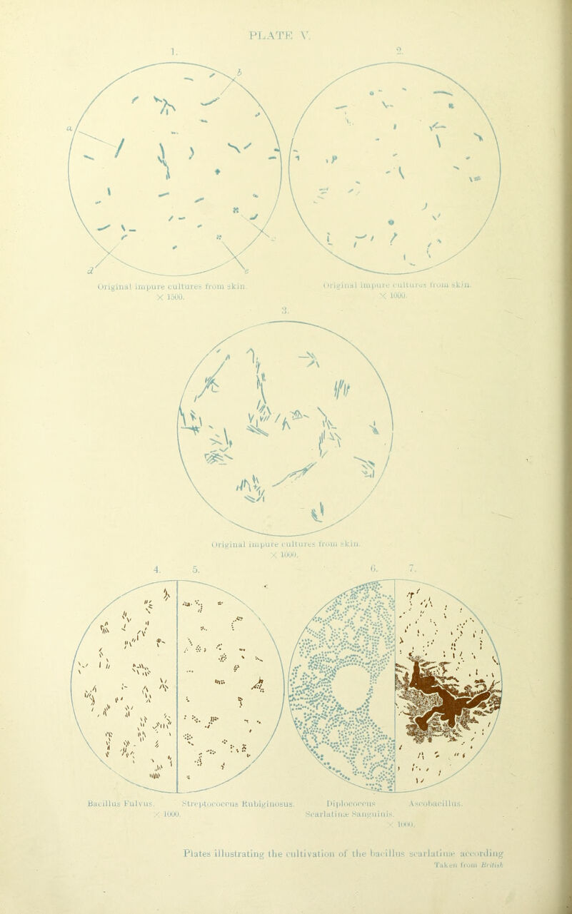 1. 3. Original impure cultures from skin. X 1000, Bacillus Fulyus, Streptococcus Kubiginosus. Diplocoecus Ascobacillus. X 1000 Scarlatina; Sanguinis. X 1000. Plates illustrating the cultivation of the bacillus scarlatina? according Taken from British