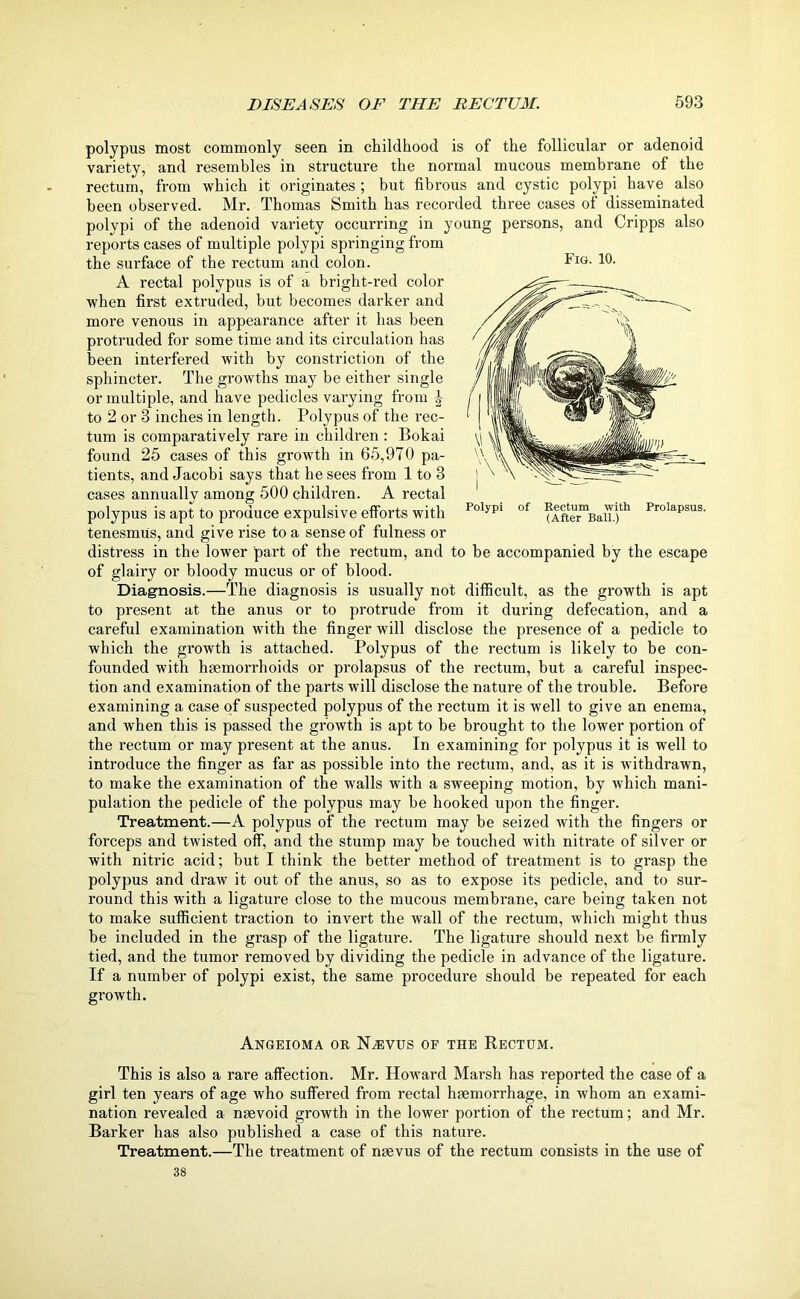 Fig. 10. Polypi of Rectum with (After Ball.) Prolapsus. polypus most commonly seen in childhood is of the follicular or adenoid variety, and resembles in structure the normal mucous membrane of the rectum, from which it originates ; but fibrous and cystic polypi have also been observed. Mr. Thomas Smith has recorded three cases of disseminated polypi of the adenoid variety occurring in young persons, and Cripps also reports cases of multiple polypi springing from the surface of the rectum and colon. A rectal polypus is of a bright-red color when first extruded, but becomes darker and more venous in appearance after it has been protruded for some time and its circulation has been interfered with by constriction of the sphincter. The growths may be either single or multiple, and have pedicles varying from J to 2 or 3 inches in length. Polypus of the rec- tum is comparatively rare in children : Bokai found 25 cases of this growth in 65,970 pa- tients, and Jacobi says that he sees from 1 to 3 cases annually among 500 children. A rectal polypus is apt to produce expulsive efforts with tenesmus, and give rise to a sense of fulness or distress in the lower part of the rectum, and to be accompanied by the escape of glairy or bloody mucus or of blood. Diagnosis.—The diagnosis is usually not difficult, as the growth is apt to present at the anus or to protrude from it during defecation, and a careful examination with the finger will disclose the presence of a pedicle to which the growth is attached. Polypus of the rectum is likely to be con- founded with hemorrhoids or prolapsus of the rectum, but a careful inspec- tion and examination of the parts will disclose the nature of the trouble. Before examining a case of suspected polypus of the rectum it is well to give an enema, and when this is passed the growth is apt to be brought to the lower portion of the rectum or may present at the anus. In examining for polypus it is well to introduce the finger as far as possible into the rectum, and, as it is withdrawn, to make the examination of the walls with a sweeping motion, by which mani- pulation the pedicle of the polypus may be hooked upon the finger. Treatment.—A polypus of the rectum may be seized with the fingers or forceps and twisted off, and the stump may be touched with nitrate of silver or with nitric acid; but I think the better method of treatment is to grasp the polypus and draw it out of the anus, so as to expose its pedicle, and to sur- round this with a ligature close to the mucous membrane, care being taken not to make sufficient traction to invert the wall of the rectum, which might thus be included in the grasp of the ligature. The ligature should next be firmly tied, and the tumor removed by dividing the pedicle in advance of the ligature. If a number of polypi exist, the same procedure should be repeated for each growth. Angeioma or ISLevus of the Rectum. This is also a rare affection. Mr. Howard Marsh has reported the case of a girl ten years of age who suffered from rectal haemorrhage, in whom an exami- nation revealed a naevoid growth in the lower portion of the rectum; and Mr. Barker has also published a case of this nature. Treatment.—The treatment of naevus of the rectum consists in the use of 38