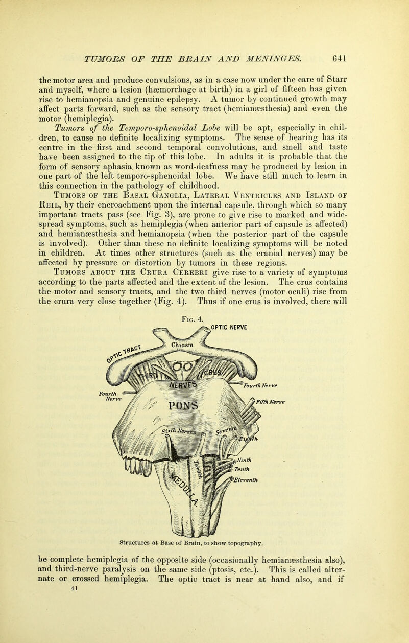 the motor area and produce convulsions, as in a case now under the care of Starr and myself, where a lesion (haemorrhage at birth) in a girl of fifteen has given rise to hemianopsia and genuine epilepsy. A tumor by continued growth may affect parts forward, such as the sensory tract (hemianaesthesia) and even the motor (hemiplegia). Tumors of the Temporo-sphenoidal Lohe will be apt, especially in chil- dren, to cause no definite localizing symptoms. The sense of hearing has its centre in the first and second temporal convolutions, and smell and taste have been assigned to the tip of this lobe. In adults it is probable that the form of sensory aphasia known as word-deafness may be produced by lesion in one part of the left temporo-sphenoidal lobe. We have still much to learn in this connection in the pathology of childhood. Tumors of the Basal Ganglia, Lateral Ventricles and Island of Reil, by their encroachment upon the internal capsule, through which so many important tracts pass (see Fig. 3), are prone to give rise to marked and wide- spread symptoms, such as hemiplegia (when anterior part of capsule is affected) and hemianaesthesia and hemianopsia (when the posterior part of the capsule is involved). Other than these no definite localizing symptoms will be noted in children. At times other structures (such as the cranial nerves) may be affected by pressure or distortion by tumors in these regions. Tumors about the Crura Cerebri give rise to a variety of symptoms according to the parts affected and the extent of the lesion. The crus contains the motor and sensory tracts, and the two third nerves (motor oculi) rise from the crura very close together (Fig. 4). Thus if one crus is involved, there will Fig. 4. be complete hemiplegia of the opposite side (occasionally hemianaesthesia also), and third-nerve paralysis on the same side (ptosis, etc.). This is called alter- nate or crossed hemiplegia. The optic tract is near at hand also, and if 41