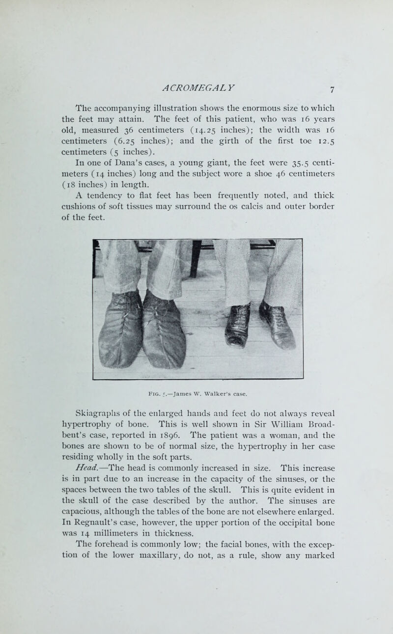 The accompanying illustration shows the enormous size to which the feet may attain. The feet of this patient, who was 16 years old, measured 36 centimeters (14.25 inches); the width was 16 centimeters (6.25 inches); and the girth of the first toe 12.5 centimeters (5 inches). In one of Dana's cases, a young giant, the feet were 35.5 centi- meters (14 inches) long and the subject wore a shoe 46 centimeters (18 inches) in length. A tendency to flat feet has been frequently noted, and thick cushions of soft tissues may surround the os calcis and outer border of the feet. Fig. f.—James \V. Walker's ease. Skiagraphs of the enlarged hands and feet do not always reveal hypertrophy of bone. This is well shown in Sir William Broad- bent's case, reported in 1896. The patient was a woman, and the bones are shown to be of normal size, the hypertrophy in her case residing wholly in the soft parts. Head.—The head is commonly increased in size. This increase is in part due to an increase in the capacity of the sinuses, or the spaces between the two tables of the skull. This is quite evident in the skull of the case described by the author. The sinuses are capacious, although the tables of the bone are not elsewhere enlarged. In Regnault's case, however, the upper portion of the occipital bone was 14 millimeters in thickness. The forehead is commonly low; the facial bones, with the excep- tion of the lower maxillary, do not, as a rule, show any marked