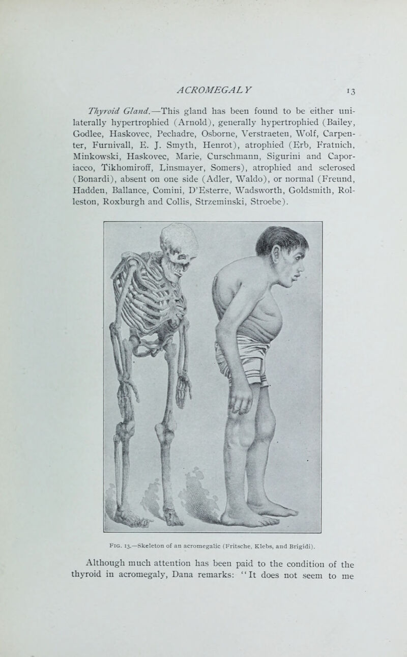 t3 Thyroid Gland.—This gland has been found to be either uni- laterally hypertrophied (Arnold), generally hypertrophied (Bailey, Godlee, Haskovee, Pechadre, Osborne, Verstraeteu, Wolf, Carpen- ter, Furuivall, E. J. Smyth, Henrot), atrophied (Erb, Fratuich, Minkowski, Haskovee, Marie, Curschmann, Sigurini and Capor- iaeeo, Tikhomiroff, Linsmayer, Somers), atrophied and sclerosed (Bonardi), absent on one side (Adler, Waldo), or normal (Freuud, Hadden, Ballance, Comini, D'Esterre, Wadsworth, Goldsmith, Rol- leston, Roxburgh and Collis, Strzeminski, Stroebe). Fig. 13.—Skeleton of an acromegalic (Fritsche, Klebs, and Brigidi). Although much attention has been paid to the condition of the thyroid in acromegaly, Dana remarks: It does not seem to me