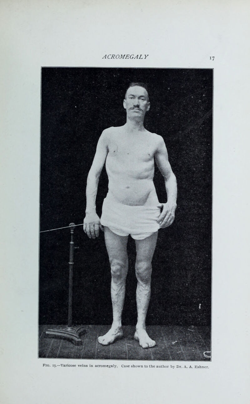 Fig. 15.—Varicose veins in acromegaly. Case shown to the author by Dr. A. A. Eshner.