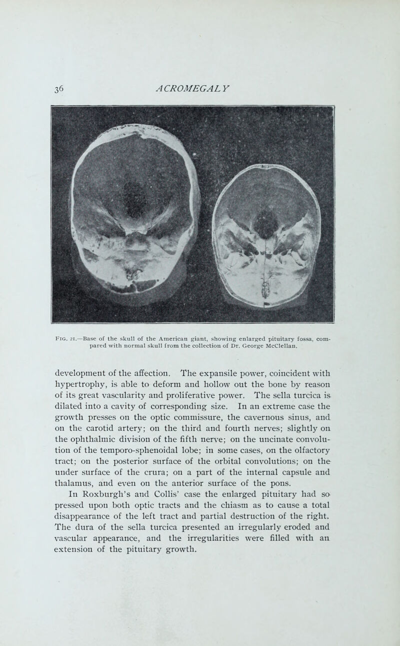 Fig. 21.—Base of the skull of the American giant, showing enlarged pituitary fossa, com- pared with normal skull from the collection of Dr. George McClellau. development of the affection. The expansile power, coincident with hypertrophy, is able to deform and hollow out the bone by reason of its great vascularity and proliferative power. The sella turcica is dilated into a cavity of corresponding size. In an extreme case the growth presses on the optic commissure, the cavernous sinus, and on the carotid artery; on the third and fourth nerves; slightly on the ophthalmic division of the fifth nerve; on the uncinate convolu- tion of the temporo-sphenoidal lobe; in some cases, on the olfactory tract; on the posterior surface of the orbital convolutions; on the under surface of the crura; on a part of the internal capsule and thalamus, and even on the anterior surface of the pons. In Roxburgh's and Collis' case the enlarged pituitary had so pressed upon both optic tracts and the chiasm as to cause a total disappearance of the left tract and partial destruction of the right. The dura of the sella turcica presented an irregularly eroded and vascular appearance, and the irregularities were filled with an extension of the pituitary growth.