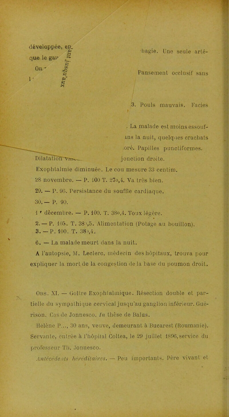 développée, en, R) que le gau >• On c 03 *Q 1 ■ c pi c X hagie. Une seule arté- Pansemenl occlusif sans 3. Pouls mauvais. Faciès . La malade est moins essouf- xns la nuit, quelques crachats .oré. Papilles punctiformes, jonction droite. Exophtalmie diminuée. Le cou mesure 33 cenlim. 28 novembre. — P. 100 T. 27o,4. Va très bien. 29. — P. 90. Persistance du souffle cardiaque. 30. — P. 90. 1 r décembre. — P. 100. T. 38o,4. Toux légère. 2. — P. 105. T. 38g5. Alimentation (Potage au bouillon). 3. — P. 100. T. 38>,4. 6. — La malade meurt dans la nuit. A l’autopsie, M. Leclerc, médecin des hôpitaux, trouva pour expliquer la mort de la congestion de la base du poumon droit. Obs. XI. — Goitre Exophlalmique. Résection double et par- tielle du sympathique cervical jusqu’au ganglion inférieur. Gué- rison. .Cas de Jonnesco. In thèse de Balus. Hélène P..., 30 ans, veuve, demeurant à Bucarest (Roumanie). Servante, entrée à l’hôpital Coltea, le 29 juillet 1896,service du professeur Th. .Jonnesco. AnléGëde.ils hnnidilaires. — Peu importants. Père vivant et