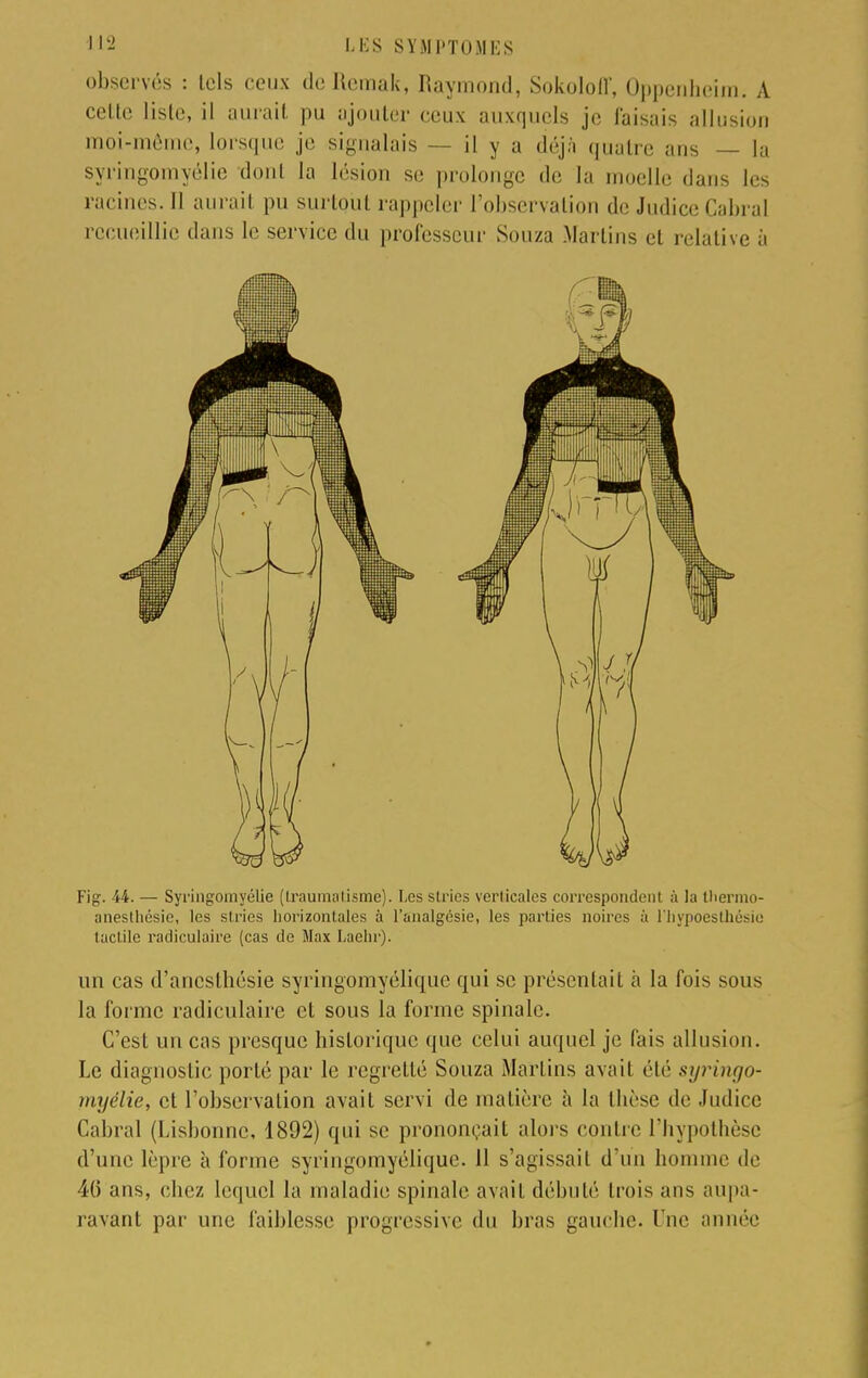 observés : tels ceux deRemak, Raymond, Sokololl', Oppenheim; A celte liste, il aurait pu ajouter ceux auxquels je taisais allusion moi-même, lorsque je signalais il y a déjà quatre ans — la syringomyélie dont la lésion si; prolonge de la moelle dans les racines. 11 aurait pu surtout rappeler l'observation de Judice Cabrai recueillie clans le service du professeur Souza Martins et relative à Fig. 44. — Syringomyélie (traumatisme). Les stries verticales correspondent à la therrao- anesthésie, les stries horizontales à l'analgésie, les parties noires à l'hypoesthésic tactile radiculaire (cas de Max Laehr). un cas d'ancslhésie syringomyélique qui se présentait à la fois sous la forme radiculaire et sous la forme spinale. C'est un cas presque historique que celui auquel je fais allusion. Le diagnostic porté par le regretté Souza Martins avait été syringo- myélie, et l'observation avait servi de matière à la thèse de Judice Cabrai (Lisbonne, 1892) qui se prononçait alors contre l'hypothèse d'une lèpre à forme syringomyélique. 11 s'agissait d'un homme de 40 ans, chez lequel la maladie spinale avait débuté trois ans aupa- ravant par une faiblesse progressive du bras gauche. Une année