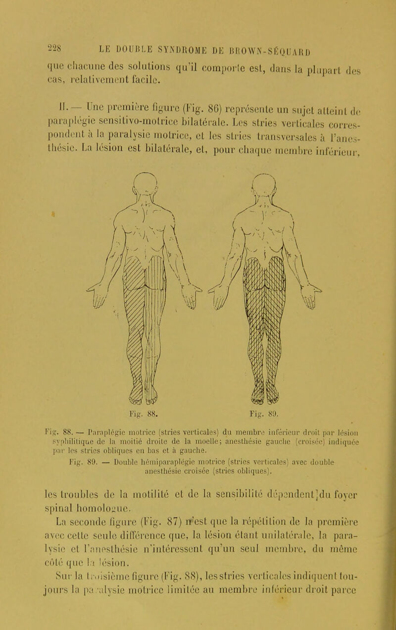 que chacune des solutions qu'il comporte est, dans la plupart des ( iis. relativement facile. II. - Une première figure (Fig. 86) représente un sujet atteint de paraplégie sensitivo-motricc bilatérale. Les stries verticales corres- pondent à la paralysie motrice, et les stries transversales à Panes- thésic. In lésion est bilatérale, et, pour chaque membre inférieur, Kg. 88. Fig. 89. Fig. 88. — Paraplégie motrice (stries verticales) du membre inférieur droit par lésion syphilitique de la nioilié droite de la moelle; anestliésie gauche [croisée] indiquée par les stries obliques en bas et à gauche. Fig. 89. — Double hémiparaplégie motrice (stries verticales) avec double anestliésie croisée (stries obliques). les troubles de la motilité et de la sensibilité dépendentjdu foyer spinal homologue. La seconde ligure (Fig. 87) rr'cst que la répétition de la première avec cette seule différence que, la lésion étanl unilatérale, la para- lysie et l'anesthésie n'intéressent qu'un seul membre, du môme côté que la lésion. Sur la troisième figure (Fig. 88), les stries verticales indiquent tou- jours la pa alysic motrice limitée au membre inférieur droit parce