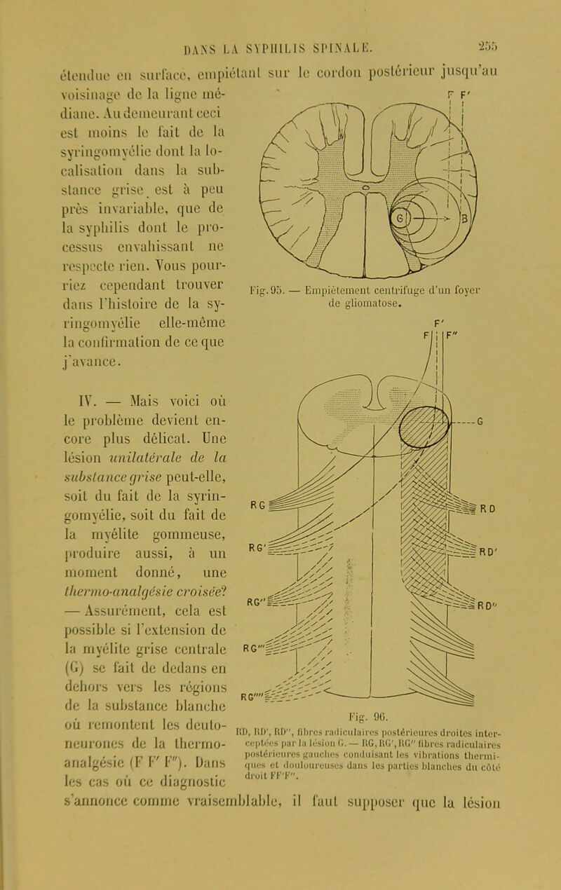 étendue en surface, empiétant sur le cordon postérieur jusqu'au voisinage de la ligue mé- diane. A.u demeurant ceci est moins le fait de la syringomyélie dont la lo- calisation dans la sub- stance grise est à peu près invariable, que de la syphilis dont le pro- cessus envahissant ne respecte rien. Vous pour- riez cependant trouver dans l'histoire de la sy- ringomyélie elle-même la confirmation de ce que j'avance. Fig.95. — Empiétement centrifuge d'un foyer tic gliomatose. IV. — Mais voici où le problème devient en- core plus délicat. Une lésion unilatérale de la substa nce grise peut-elle, soit du fait de la syrin- gomyélie, soit du fait de la myélite gommeuse, produire aussi, à un moment donné, une thermo-analgésie croisée? — Assurément, cela est possible si l'extension de la myélite grise centrale (G) se fait de dedans en dehors vers les régions de la substance blanche où remontent les deulo- oeurones de la thermo- analgésie (F P F). Dans les cas où ce diagnostic s'annonce comme vraisemblable, il faut supposer que la lésion RG'g#2 RGi-'VJ-r-' Fig. 90. lil). IU)', ltl>, libres radiculaires postérieures droites inter- ceptées par la lésion <;. — I!G, lui', UG libres radiculaires postérieures gauches conduisant les vibrations thermi- ques et douloureuses dans les parties blanches du colé droit FF'F.