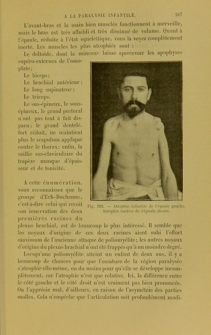 L'avaat-bras et ta main bien musclés fonctionnent à merveille, mais le bras est très affaibli et très diminué de volume. Quant à l'épaule, réduite à l'état squelellique, vous la voyez complètement inerte. Les muscles les plus atrophiés sont : Le deltoïde, dont la minceur laisse apercevoir les apopbyses supéro-externes de l'omo- plate; Le biceps; Le brachial antérieur; Le long supinatcur : Le triceps. Le sus-épineux, le sous- épineux, le grand pectoral n'ont pas tout à fait dis- paru: le grand dentelé, fort réduit, ne maintient plus le seapulum appliqué contre le thorax; enfin, la saillie sus-claviculaire du trapèze manque d'épais- seur et de tonicité. A celte énuméralion, vous reconnaissez que le groupe d'Erb-Duchenne, c'est-à-dire celui qui reçoit son innervation des deux premières racines du plexus brachial, est de beaucoup le plus intéressé. Il semble que les noyaux d'origine de ces deux racines aient subi l'effort maximum de l'ancienne attaque de poliomyélite; les autres noyaux d'origine du plexus brachial n'ont été frappés qu'à un moindre degré. Lorsqu'une poliomyélite atteint un enfant de deux ans, il y a beaucoup de chances pour que l'ossature de la région paralysée s'atrophie elle-même, ou du moins pour qu'elle se développe incom- plètement, car l'atrophie n'est que relative. Ici, la différence entre le côté; gauche et le côté droit n'est vraiment pas bien prononcée. On l'apprécie mal, d'ailleurs, en raison de l'asymétrie des parties molles. Cela n'empêche que l'articulation soit profondément modi- 102. — Atrophie infantile de L'épaule gauche. Atrophie tardive de l'épaule droite.