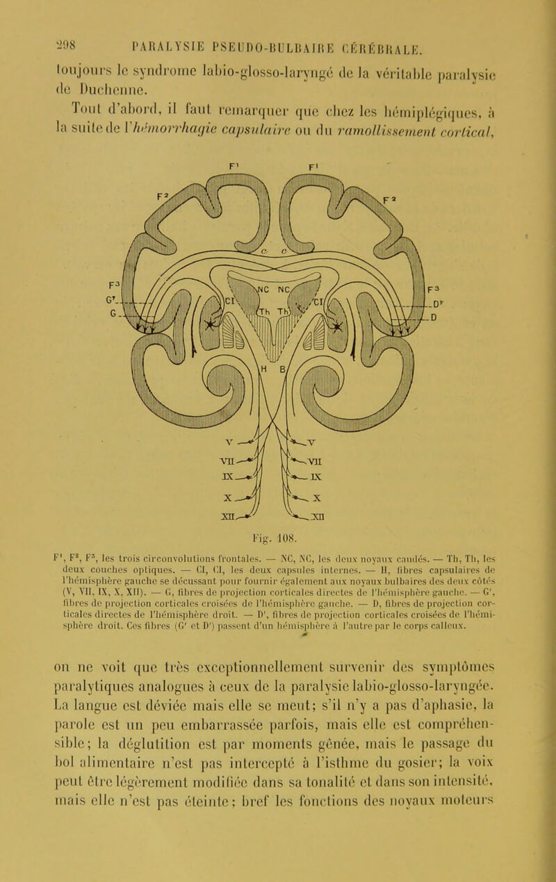 toujours le syndrome labio.glosso-laryngé de la véritable paralysie de Duchenne. Tonl d'abord, il faut remarquer que chez les hémiplégiques, à la suilede Yhèmorrhagie capsulaire ou du ramollissement cortical, F> F> Fig. MIS. F1, F*, Fa, les trois circonvolutions Frontales. — NC, NC, les deux noyaux caudés. — Th. Th, les deux couches optiques. — CI, 01, les deux capsules internes. — 11, libres capsulaires de l'hémisphère gauche se décussant pour fournir également aux noyaux bulbaires des deux cotés (V, Vil. IX, X, XII). — G, libres de projection corticales directes de l'hémisphère gauche. — G', fibres de projection corticales croisées de l'hémisphère gauche. — D, fibres de projection cor- ticales directes de l'hémisphère droit. — 1)', libres de projection corticales croisées de l'hémi- sphère droit. Ces libres (G' et I)') passent d'un hémisphère à l'autre par le corps calleux. on ne voit que très exceptionnellement survenir dos symptômes paralytiques analogues à ceux de la paralysie labio-glosso-laryngée. La langue est déviée mais elle se nient; s'il n'y a pas d'aphasie, la parole est un peu embarrassée parfois, mais elle est compréhen- sible; la déglutition est par moments gênée, niais le passage du bol alimentaire n'est pas intercepté à l'isthme du gosier; la voix peut rire légèrement modifiée dans sa tonalité et dans son intensité, mais elle n'esl pas éteinte; bref les fonctions des noyaux moteurs