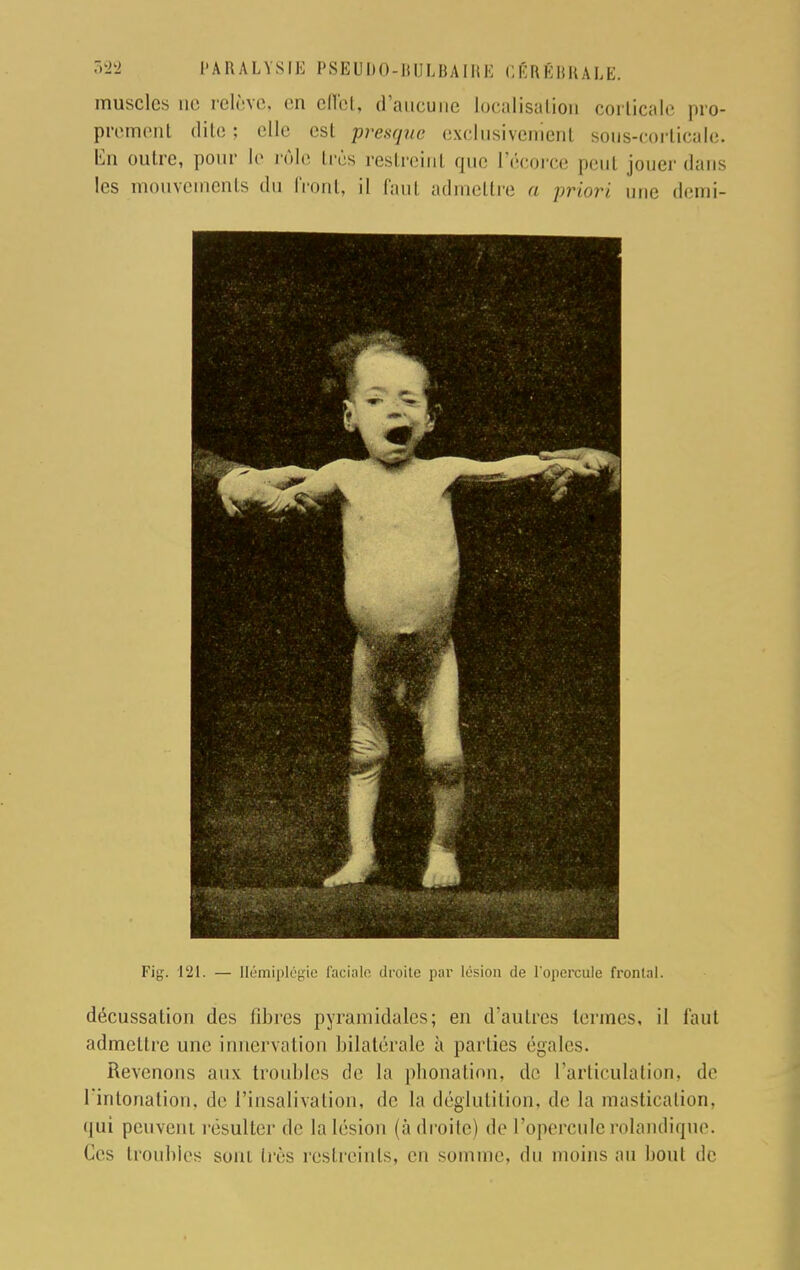 muscles ne relevé, en effet, d'aucune Localisation corticale pro- prement dite : elle est presque exclusivement sous-corticale, lin outre, pour le rôle très restreinl que l'écorce peu! jouer dans les mouvements du front, il faut admettre a priori une demi- Fig. 121. — Hémiplégie faciale droite par lésion de l'opercule frontal. décussation des fibres pyramidales; en d'autres termes, il faut admettre une innervation bilatérale à parties égales. Revenons aux troubles de la phonation, de l'articulation, de l'intonation, de l'insalivation, de la déglutition, de la mastication, qui peuveni résulter de lalésion (à droite) de l'operculerolandique. Ces troubles sont très restreints, en somme, du moins au bout de