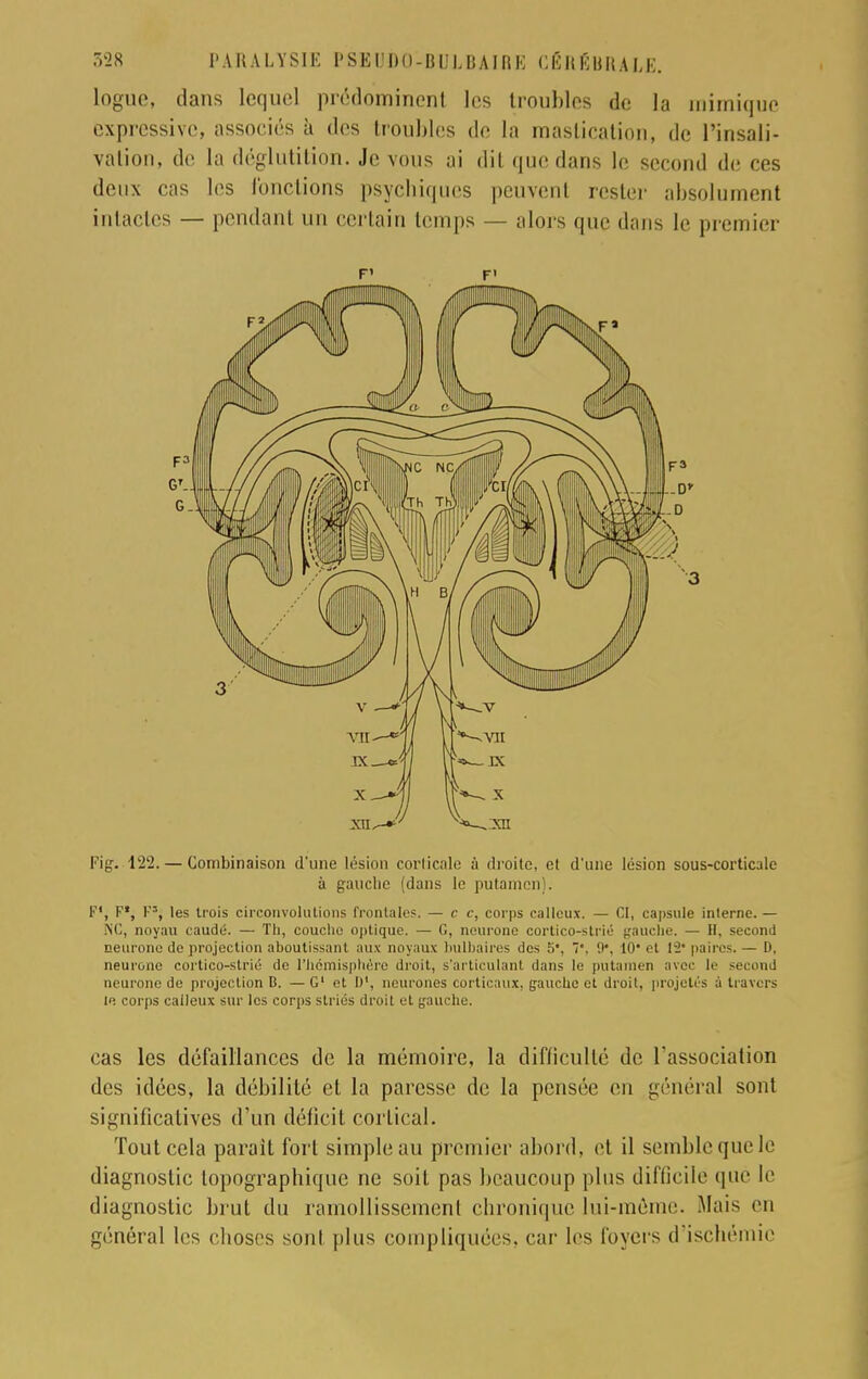 logue, dans lequel prédominent les troubles de la mimique expressive, associés à des troubles de la mastication, de l'insali- vation, de la déglutition. Je vous ai dit que dans le second de ces deux cas les fonctions psychiques peuvent rester absolument intactes — pendant un certain temps — alors que dans le premier F' F' Fig. 122. — Combinaison d'une lésion corticale à droite, et d'une lésion sous-corticale à gauche (dans le putamen). F', F*, F3, les trois circonvolutions frontales. — ce, corps calleux. — CI, capsule interne. — NC, noyau caudé. — Th, couche optique. — G, neurone cortico-strié gauche. — H, second neurone de projection aboutissant aux noyaux bulbaires des î>\ '. 9*, 10* et 12' paires. — D, neurone cortico-strié de l'hémisphère droit, s'articulant dans le putamen avec le second neurone de projection B. — G1 et D1, neurones corticaux, gauche et droit, projetés à travers le corps calleux sur les corps striés droit et gauche. cas les défaillances de la mémoire, la difficulté de l'association des idées, la débilité et la paresse de la pensée en général sont significatives d'un déficit cortical. Tout cela parait fort simple au premier abord, et il semble que le diagnostic lopographique ne soit pas beaucoup plus difficile que le diagnostic brut du ramollissement chronique lui-môme. Mais en général les choses sont plus compliquées, car les loyers d'ischémie