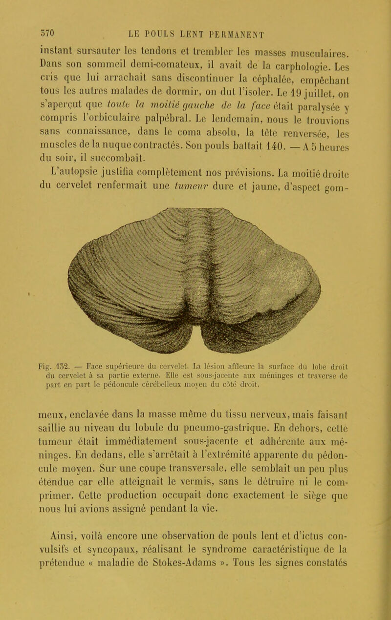 instant sursauter les tendons et trembler les masses musculaires. Dans son sommeil dcmi-comalcux, il avail de La carphologie. Les cris que lui arrachait sans discontinuer la céphalée, empêchant tous les autres malades de dormir, on dut l'isoler. Le 19 juillet, on s'aperçut que touti la moitié gauche de la face était paralysée y compris l'orbiculaire palpébral. Le lendemain, nous le trouvions sans connaissance, dans le coma absolu, la tète renversée, les muscles de la nuque contractés. Son pouls battait 140. — A 5 heure- du soir, il succombait. L'autopsie justilia complètement nos prévisions. La moitié droite du cervelet renfermait une tumeur dure et jaune, d'aspect gom- Fig. 152. — Face supérieure du cervelet. La lésion affleure la surface du lobe droit du cervelet à sa partie externe. Elle est sous-jacente aux méninges et traverse de pari en part le pédoncule cérébelleux moyen du côté droit. meux, enclavée dans la masse même du tissu nerveux, mais faisant saillie au niveau du lobule du pneumo-gastrique. En dehors, celle tumeur élait immédiatement sous-jacente et adhérente aux mé- ninges. En dedans, elle s'arrêtait à l'extrémité apparente du pédon- cule moyen. Sur une coupe transversale, elle semblait un peu plus étendue car elle atteignait le vermis, sans le détruire ni le com- primer. Cette production occupait donc exactement le siège que nous lui avions assigné pendant la vie. Ainsi, voilà encore une observation de pouls lent et d'ictus con- vulsifs et syncopaux, réalisant le syndrome caractéristique de la prétendue « maladie de Stokes-Adams ». Tous les signes constatés