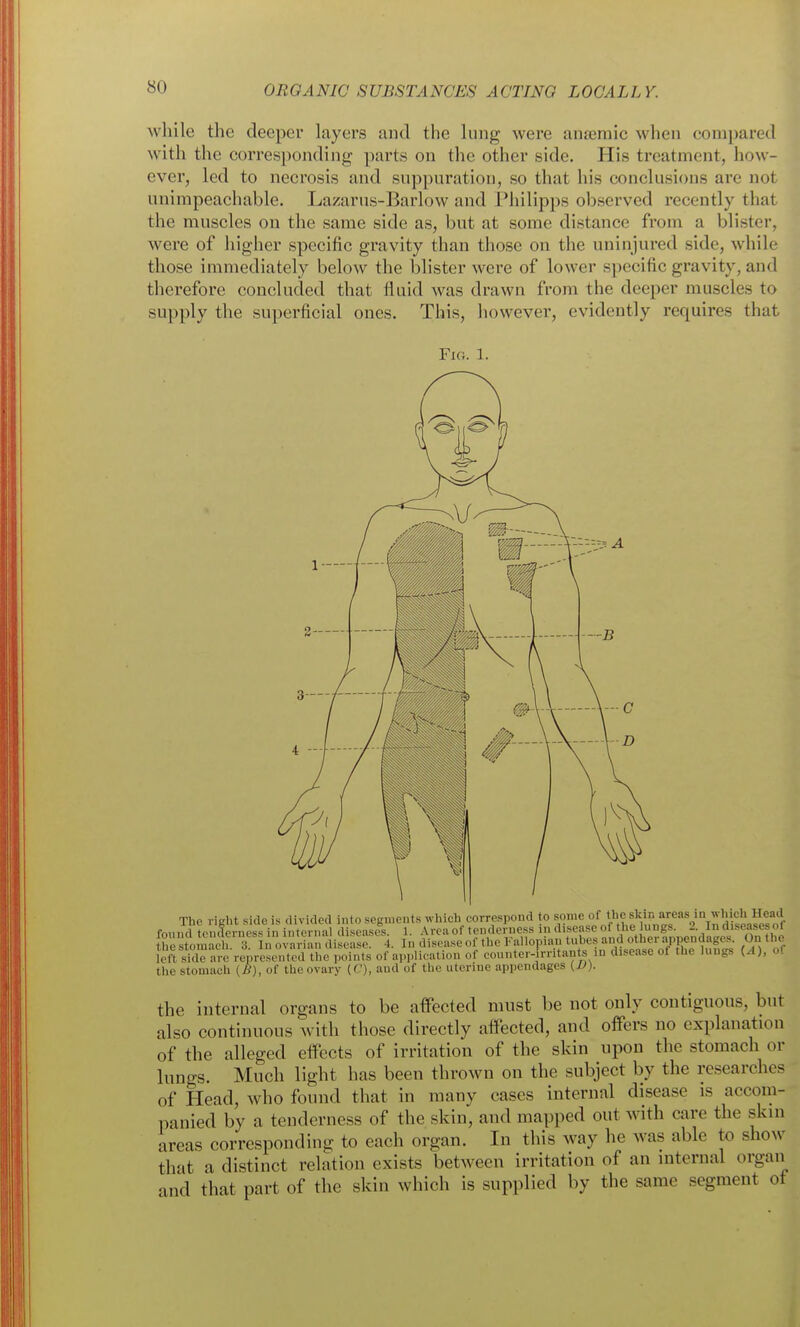 while the deeper layers and the lung were anamic when compared with the corresponding parts on the other side. His treatment, how- ever, led to necrosis and suppuration, so that his conclusions arc not unimpeachable. Lazarus-Barlow and Philipps observed recently that the muscles ou the same side as, but at some distance fx'om a blister, were of higher specific gravity than those on the uninjured side, while those immediately below the blister were of lower specific gravity, and therefore concluded that fluid was drawn from the deeper muscles to supply the superficial ones. This, however, evidently requires that Fig. 1. The right side is divided into segments which correspond to ^'^ ^'^^^^f/.f^^^^^ found tenderness in internal diseases. 1. Area of tenderness in disease of the lungs. 2. In diseases ol t he stoSr 3 In ovarian disease. 4. In disease of the Fallopian tubes and other appendages. On the left sUIe areVe^es^^^^^^^^ points of application of counter- rritants in dise.ase of the lungs (.1), o! the stomach (B), of thoovary [C), and of the uterine appendages {V). the internal organs to be affected must be not only contiguous, but also continuous with those directly affected, and offers no explanation of the alleged effects of irritation of the skin upon the stomach or lungs. Much light has been thrown on the subject by the researches of Head, who found that in many cases internal disease is accom- panied by a tenderness of the skin, and mapped out with care the skin areas corresponding to each organ. In this way he was able to show that a distinct relation exists between irritation of an internal organ and that part of the skin which is supplied by the same segment ot
