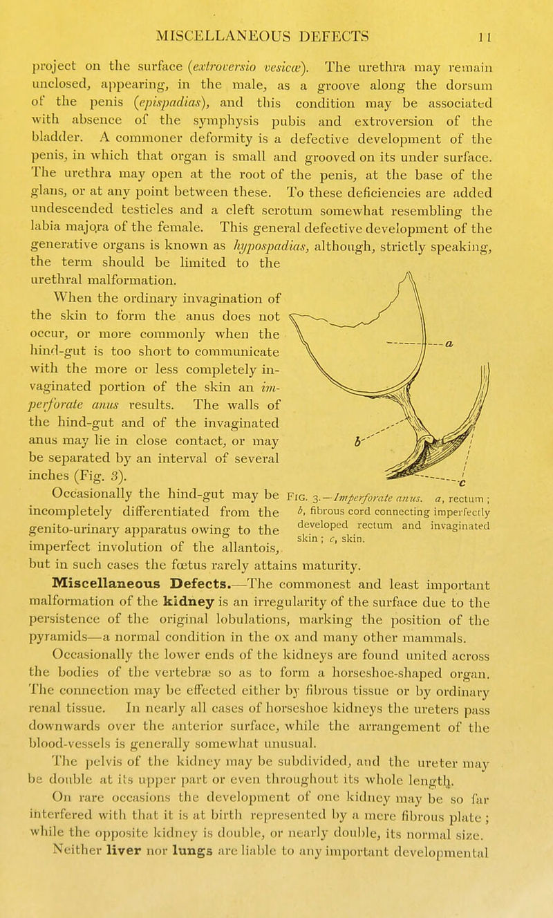 MISCELLANEOUS DEFECTS {)roject on the surface {extroversio vesica;). The uretlira may remain unclosed, appearing, in the male, as a groove along the dorsum of the penis (epispadias), and this condition may be associated with absence of the symphysis pubis and extroversion of the bladder. A commoner deformity is a defective development of the penis, in which that organ is small and grooved on its under surface. The urethra may open at the root of the penis, at the base of the glans, or at any point between these. To these deficiencies are added undescended testicles and a cleft scrotum somewhat resembling the labia majqra of the female. This general defective development of the generative organs is known as hypospadias, although, strictly speaking, the term should be limited to the urethral malformation. J\ When the ordinary invagination of / \ the skin to form the anus does not \ occur, or more commonly when the \ | hind-gut is too short to communicate \ 7f with the more or less completely in- \. yj || | vaginated portion of the skin an im- ^^'^5==^^^^ iv perforate amis i-esults. The walls of '^'^^l JfJ the hind-gut and of the invaginated //^ anus may lie in close contact, or may 3''' M^^W'' be separated by an interval of several ''' inches (Fig. 3). i^^^, ^ Occasionally the hind-gut may be Fig. Imperforate anus, a, rectum; Incompletely differentiated from the fibrous cord connecting imperfectly genito-urinary apparatus owing to the developed rectum and invaginated . / . n , slcin; c, sldn. impertect mvolution or the allantois, but in such cases the foetus rarely attains maturity. IVIiscellaneous Defects.—The commonest and least important malformation of the kidney is an irregularity of the surface due to the persistence of the original lobulations, marking the position of the pyramids—a normal condition in the ox and many other mammals. Occasionally the lower ends of the kidneys are found united across the bodies of the vertebrae so as to form a horseshoe-shaped organ. The connection may be effected either by fibrous tissue or by ordinary renal tissue. In nearly all cases of horseshoe kidneys the ureters pass downwards over the anterior surface, while the arrangement of the blood-vessels is generally somewhat unusual. The pelvis of the kidney may be subdivided, and the ureter may be double at its upper part or even througliout its whole length. On rare occasions the development of one kidney may be so far interfered with that it is at birth represented by a mere fibrous plate ; while the opposite kidney is double, or nearly double, its normal size. Neither liver nor lungs are liable to any important developmental