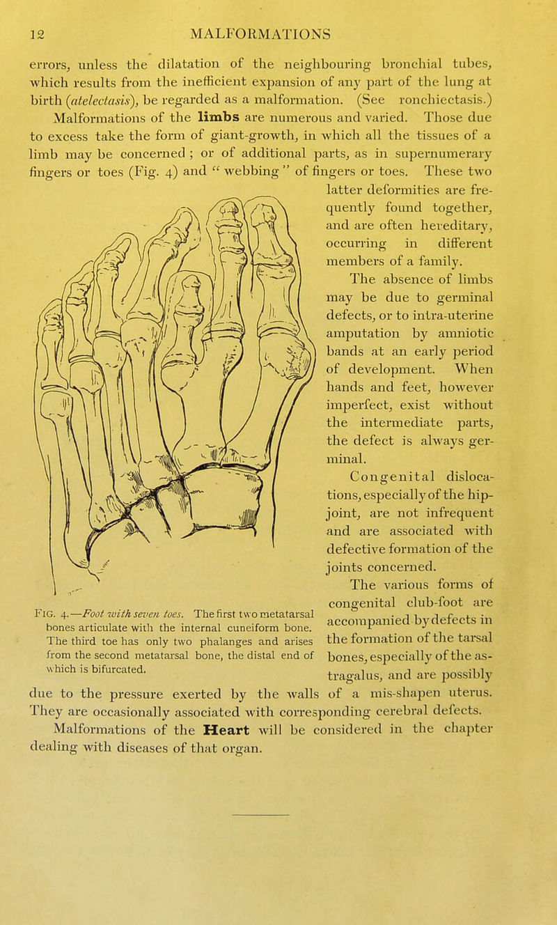 errors, unless the dilatation of the neighbouring bronchial tubes, which results from the inefficient expansion of any part of the lung at birth (citeleciasis), be regarded as a malformation. (See ronchiectasis.) Malformations of the limbs are numerous and varied. Those due to excess take the forin of giant-growth, in which all the tissues of a limb may be concerned ; or of additional parts, as in supernumerary fingers or toes (Fig. 4) and webbing of fingers or toes. These two latter deformities are fre- quently found together, and are often hereditary, occurring in different members of a family. The absence of limbs may be due to germinal defects, or to inlra-uterine amputation by amniotic bands at an early period of development. When hands and feet, however imperfect, exist without the intermediate parts, the defect is always ger- minal. Congenital disloca- tions, especially of the hip- joint, are not infrequent and are associated with defective formation of the joints concerned. The various forms of congenital club-foot are accompanied by defects in the formation of the tarsal bones, especially of the as- tragalus, and are possibly due to the pressure exerted by the walls of a mis-shapen uterus. They are occasionally associated with corresponding cerebral defects. Malformations of the Heart will be considered in the chai)ter dealing with diseases of tliat organ. Fig. 4.—Foot 2vitk seven toes. The first two metatarsal bones articulate with the internal cuneiform bone. The third toe has only two phalanges and arises from the second metatarsal bone, the distal end of which is bifurcated.