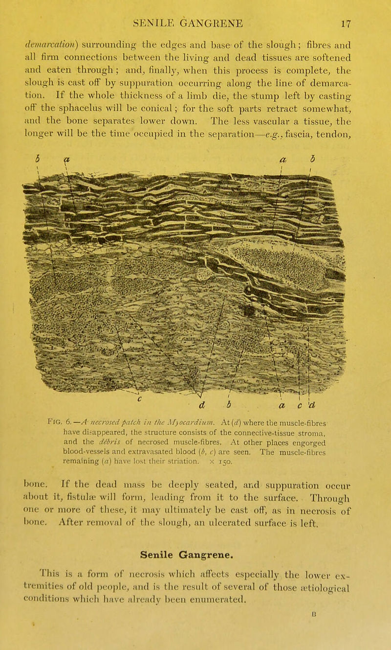 demarcation) surrounding the edges and base of the slough; fibres and all firm connections between the living and dead tissues are softened and eaten through ; and, finally, when this process is complete, the slough is cast oft by suppuration occurring along the line of demarca- tion. If the whole thickness of a limb die, the stump left by casting off the sphacelus will be conical; for the soft parts retract somewhat, and the bone separates lower down. The less vascular a tissue, the longer will be the time occupied in the separation—e.g., fascia, tendon. b a a b d b a c Fig. 6. —A- necrosed patch in the Myocardium. At (d) where the muscle-fibres have disappeared, the structure consists of the connective-tissue stroma, and the ddbris of necrosed muscle-fibres. At other places engorged blood-vessels and e,\-travasated blood [h, c) are seen. The muscle-fibres remaining [a] have lost their striation. x 150. bone. If the dead mass be deeply seated, and suppuration occur about it, fistulse will form, leading from it to the surface. Through one or more of these, it may ultimately be cast oft, as in necrosis of bone. After removal of the slough, an ulcerated surface is left. Senile Gangrene. This is a form of necrosis which aS'ects especially the lower ex- tremities of old people, and is the result of several of those ajtiological conditions which have already been enumerated. u