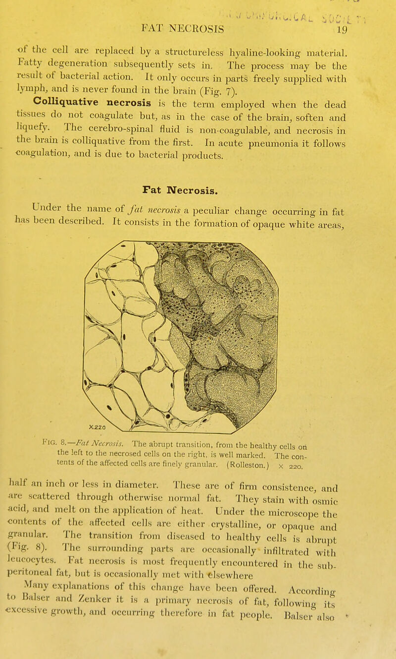 FAT NECROSIS of the cell are replaced by a structureless hyaline-looking material. Fatty degeneration subsequently sets in. The process may be the result of bacterial action. It only occurs in parts freely supplied with lymph, and is never foimd in the brain (Fig. 7). Colliquative necrosis is the teri-n employed when the dead tissues do not coagulate but, as in the case of the brain, soften and liquefy. The cerebro-spinal fluid is non-coagulable, and necrosis in the brain is colliquative from the first. In acute pneumonia it follows coagulation, and is due to bacterial products. Fat Necrosis. Under the name of fat necrosis a peculiar change occurring in fat has been described. It consists in the formation of opaque white areas. !• IG. ^.—Fat Necrosis. The abrupt transition, from the healthy cells on the left to the necrosed cells on the right, is well marked. The con- tents of the affected cells are finely granular. (Rolleston.) x 220. half an inch or less in diameter. These are of firm consistence, and are scattered through otherwise normal fat. They stain with osmic acid, and melt on the application of heat. Under the microscope the ■contents of the affected cells are either crystalline, or opaque and granular. The transition from diseased to healthy cells is abrupt (Fig. 8). The surrounding parts are occasionally infiltrated with leucocytes. Fat necrosis is most frequently encountered in the sub- peritoneal fat, but is occasionally met with elsewhere Many explanations of this change have been offered. According to Balser and Zenker it is a primary necrosis of fat, followina its excessive growth, and occurring therefore in fat people. Balsei^also