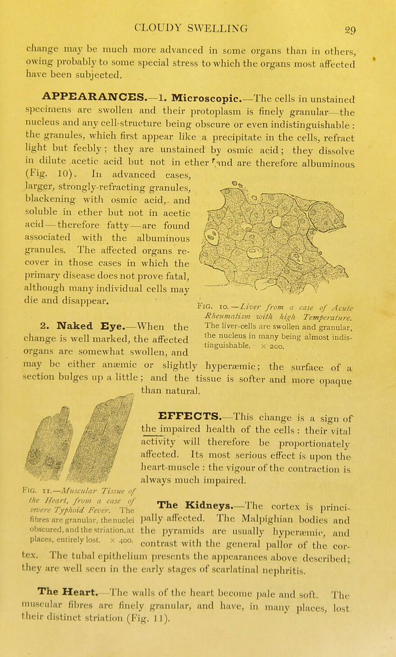 CLOUDY SWELLING cliange may be much more advanced in some organs than in otliers, owing- probably to some special stress to which the organs most affected have been subjected. APPEARANCES—1. Microscopic The cells in unstained specimens are swollen and their protoplasm is finely granular—the nucleus and any cell-structure being obscure or even indistinguishable : the granules, which first appear like a precipitate in the cells, refract light but feebly; they are unstained by osmic acid ; they dissolve in dilute acetic acid but not in ether f.Hnd are therefore albuminous (Fig. 10). In advanced cases, larger, strongly-refracting granules, blackening witii osmic acid, and soluble in ether but not in acetic acid—therefore fatty—are found associated with the albuminous granules. The affected organs re- cover in those cases in which the primary disease does not prove fatal, although many individual cells may die and disappear. Fig. io. Liver from a case of Acute- Rhnimatism with high Temperature. The liver-cells are swollen and granular, the nucleus in many being almost indis- tinguishable. X 20O. 2. Naked Eye.—When the change is well marked, the affected organs are somewhat swollen, and may be either anaemic or slightly hyperaemic; the surface of a section bulges up a little; and the tissue is softer and more opaque than natural. EFFECTS.—This change is a sign of the impaired health of the cells : their vital activity will therefore be proportionately aff'ected. Its most serious effect is upon the heart-muscle : the vigour of the contraction is always much impaired. The Kidneys.—The cortex is princi- Fig. II.—Muscular Tissue nf the Heart, from a case of severe Typhoid Fever. The - i. fibres are granular, the nuclei pally aff'ected. The Malpighian bodies and obscured, and the striation.at the pyramids are usually hypera>mic and places, entirely lost, x 400. contrast with the general pallor of the cor- tex. The tubal epithelium presents the appearances above described; they are well seen in the early stages of scarlatinal nephritis. The Heart,—The walls of the heart become pale and soft. The muscular fil)res are finely granular, and have, in many places, lost their distinct striation (Fig. 11).