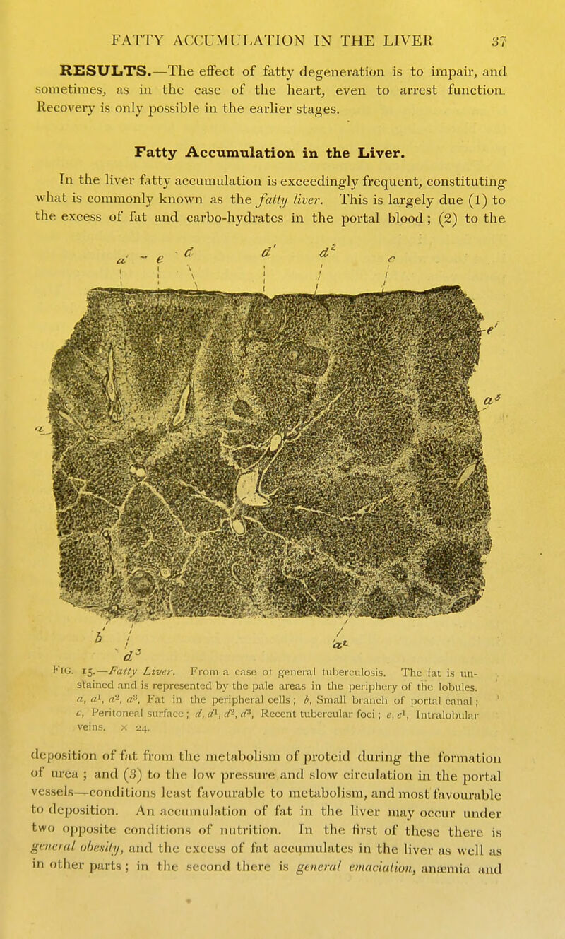 RESULTS.—The effect of fatty degeneration is to impair, and sometimes^ as in the case of the heart, even to arrest functioix Recovery is only jjossible in the earher stages. Fatty Accumulation in the Liver. In the liver fatty accumulation is exceedingly frequent, constituting what is commonly known as the fatty liver. This is largely due (l) ta the excess of fat and carbo-hydrates in the portal blood ; (2) to the Fig. 15.—Fatty Liver, From a case ot general tuberculosis. The lat is un- stained and is represented by the pale areas in the periphery of the lobules. a, «i, a?, a^, Fat in the peripheral cells ; b, Small branch of portal canal ; c. Peritoneal surface ; d, d^, cC^, d'-\ Recent tubercular foci; e,e^, Intralobular veins, x 24. deposition of fat from the metabolism of proteid during the formation of urea ; and (3) to the low pressure and slow circulation in the portal vessels—conditions least favourable to metabolism, and most favourable to deposition. An accumulation of fat in the liver may occur under two opposite conditions of nutrition. In the first of these there is getieral obesity, and the excess of fat acciimulates in the liver as well as in other parts ; in tlie second there is general emaciation, anaemia and