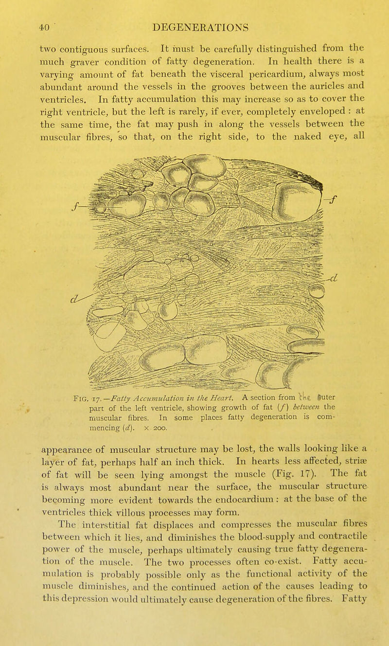 two contiguous surfaces. It mush be carefully distinguished from the much graver condition of fatty degeneration. In health there is a varying amount of fat beneath the visceral pericardium, always most abundant around the vessels in the grooves between the auricles and ventricles. In fatty accumulation this may increase so as to cover the right ventricle, but the left is rarely, if evei-, completely enveloped : at the same time, the fat may push in along the vessels between the muscular fibres, so that, on the right side, to the naked eye, all Fig. 17. —Fatty Accunmlation in the Heart. A section from tiit iDuter part of the left ventricle, showing growth of fat (/) bet'Mcen the muscular fibres. In some places fatty degeneration is com- mencing (rf). X 200. appearance of muscular structure may be lost, the walls looking like a layer of fat, perhaps half an inch thick. In hearts less affected, strife of fat will be seen lying amongst the muscle (Fig. 17). The fat is always most abundant near the surface, the muscular structure becoming more evident towards the endocardium : at the base of the ventricles thick villous processes may form. The interstitial fat displaces and compresses the muscidar fibres between which it lies, and diminishes the blood-supply and contractile power of the muscle, perhaps ultimately causing true fatty degenera- tion of the muscle. The two processes often co-exist. Fatty accu- mulation is probably possible only as the functional activity of the muscle diminishes, and the continued action of the causes leading to this depression would ultimately cause degeneration of the fibres. Fatty