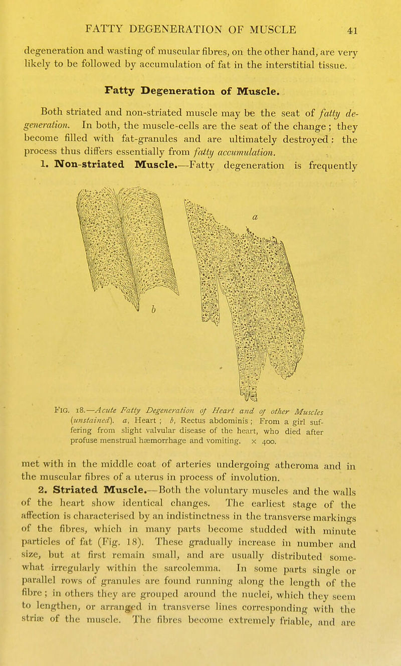 degeneration and wasting of muscular fibres^ on the other hand, are very- likely to be followed by accumulation of fat in the interstitial tissue. Fatty Degeneration of Muscle. Both striated and non-striated muscle may be the seat of fatty de- generation. In both, the muscle-cells are the seat of the change; they become filled with fat-granules and are ultimately destroyed : the process thus differs essentially from fatty accumulation. 1. Non-striated Muscle.—Fatty degeneration is frequently Fig. i8.—Acute Fatty Degeneration of Heart a?id of other Muscles {unstained), a. Heart ; b, Rectus abdominis ; From a girl suf- fering from slight valvular disease of the heart, vi^ho died after profuse menstrual haemorrhage and vomiting, x 400. met with in the middle coat of arteries undergoing atheroma and in the muscular fibres of a uterus in process of involution. 2. Striated Muscle.—Both the voluntary muscles and the walls of the heart show identical changes. The earliest stage of the affection is characterised by an indistinctness in the transverse markings of the fibres, which in many parts become studded with minute particles of fat (Fig. 18). These gradually increase in number and size, but at first remain small, and are usually distributed some- what irregularly within the sarcolemma. In some parts single or parallel rows of granules are found running along the length of the fibre; in others they are grouped around tlie nuclei, which they seem to lengthen, or arranged in transverse lines corresponding with the striae of the muscle. The fibres become extremely friable, and are