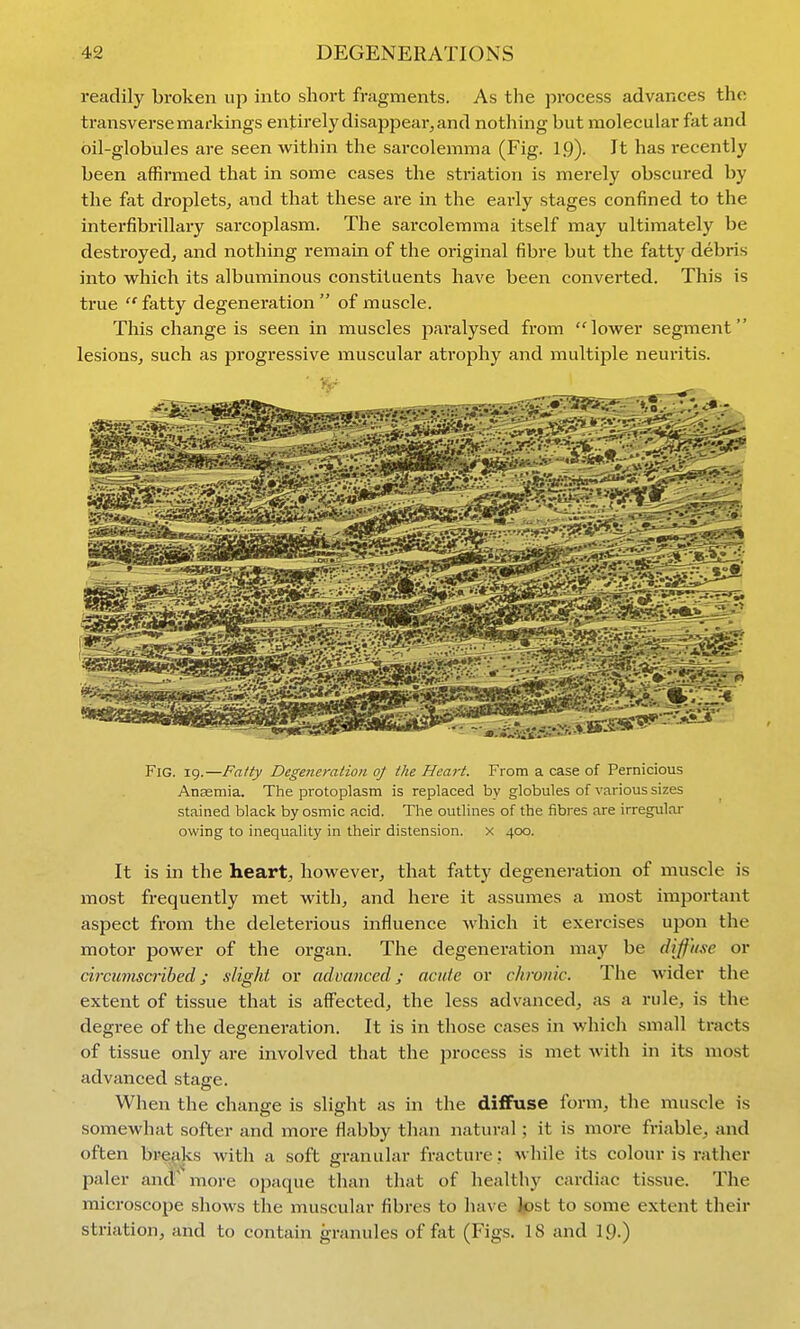readily broken up into short fragments. As the j^rocess advances the transverse markings entirely disappear, and nothing but molecular fat and bil-globules are seen within the sarcolemma (Fig. 19). It has recently been affirmed that in some cases the striation is merely obscured by the fat droplets, and that these are in the early stages confined to the interfibrillary sarcoplasm. The sarcolemma itself may ultimately be destroyed, and nothing remain of the original fibre but the fatty debris into which its albuminous constituents have been converted. This is true ''fatty degeneration of ntiuscle. This change is seen in muscles paralysed from lower segment lesions, such as progressive muscular atrophy and multiple neuritis. Fig. 19.—Fatty Degeneration of the Heart. From a case of Pernicious Ansemia. The protoplasm is replaced by globules of various sizes stained black byosmic acid. The outlines of the fibres are irregulai- owing to inequality in their distension, x 400. It is in the heart, however, that fatty degeneration of muscle is most frequently met with, and here it assumes a most important aspect from the deleterious influence which it exercises upon the motor power of the organ. The degeneration may be diffuse or drcuviscrihed; slight or advanced; acute or chronic. The wider the extent of tissue that is affected, the less advanced, as a rule, is the degree of the degeneration. It is in those cases in whicli small tracts of tissue only are involved that the process is met with in its most advanced stage. When the change is slight as in the diffuse form, the muscle is somewhat softer and more flabby than natural; it is more fi'iable, and often breaks with a soft granular fracture : while its colour is rather paler and' more opaque than that of healthy cardiac tissue. The microscope shows the muscular fibres to have Jpst to some extent their striation, and to contain granules of fat (Figs. 18 and 19-)