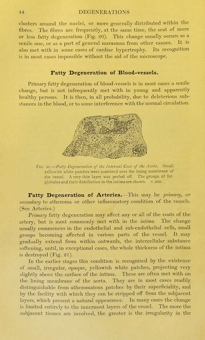 clusters around the nuclei, or more generally distributed within the fibres. The fibres are frequently, at the same time, the seat of more or less fatty degeneration (Fig. 20). This change usually occurs as a senile one, or as a part of general marasmus from other causes. It is also met with in some cases of cardiac hypertrophy. Its recognition is in most cases impossible without the aid of the microscope. Fatty Degeneration of Blood-vessels. Primary fatty degeneration of blood-vessels is in most cases a senile change, but is not infrequently met with in young and apparently healthy persons. It is then, in all probability, due to deleterious sub- stances in the blood, or to some interference with the normal circulation. Fig. 21.—Fatty Degeneratio7i of the Internal Coat of the Aorta. Small yellowish white patches were scattered over the lining membrane of the vessel. A very thin layer was peeled off. The groups of fat- globules and their distribution in the intimaare shown, x 200. Fatty Degeneration of Arteries.—This may be piimary, or .secondary to atheroma or other inflammatory condition of the vessels. (See Arteries.) Pnmarij fatty degeneration may affect any or all of the coats of the artery, but is most commonly met with in the intima. The change usually commences in the endothelial and sub-endothelial cells, smaU groups becoming affected in various parts of the vessel. It may gradually extend from within outwards, the intercellular substance softening, until, in exceptional cases, the whole thickness of the intima is destroyed (Fig. 21). In the earUer stages this condition is recognised by the existence of small, irregular, opaque, yellowish white patches, projecting very slightly above the surface of the intima. These are often met with on the lining membrane of the aorta. They are in most cases readily distinguishable from atheromatous patches by their superficialitj', and by the facility with which they can be strii)ped off from the subjacent layers, which present a natural appearance. In many cases the change is limited entirely to the innermost layers of the vessel. The more the subjacent tissues are involved, the greater is the irregularity in the