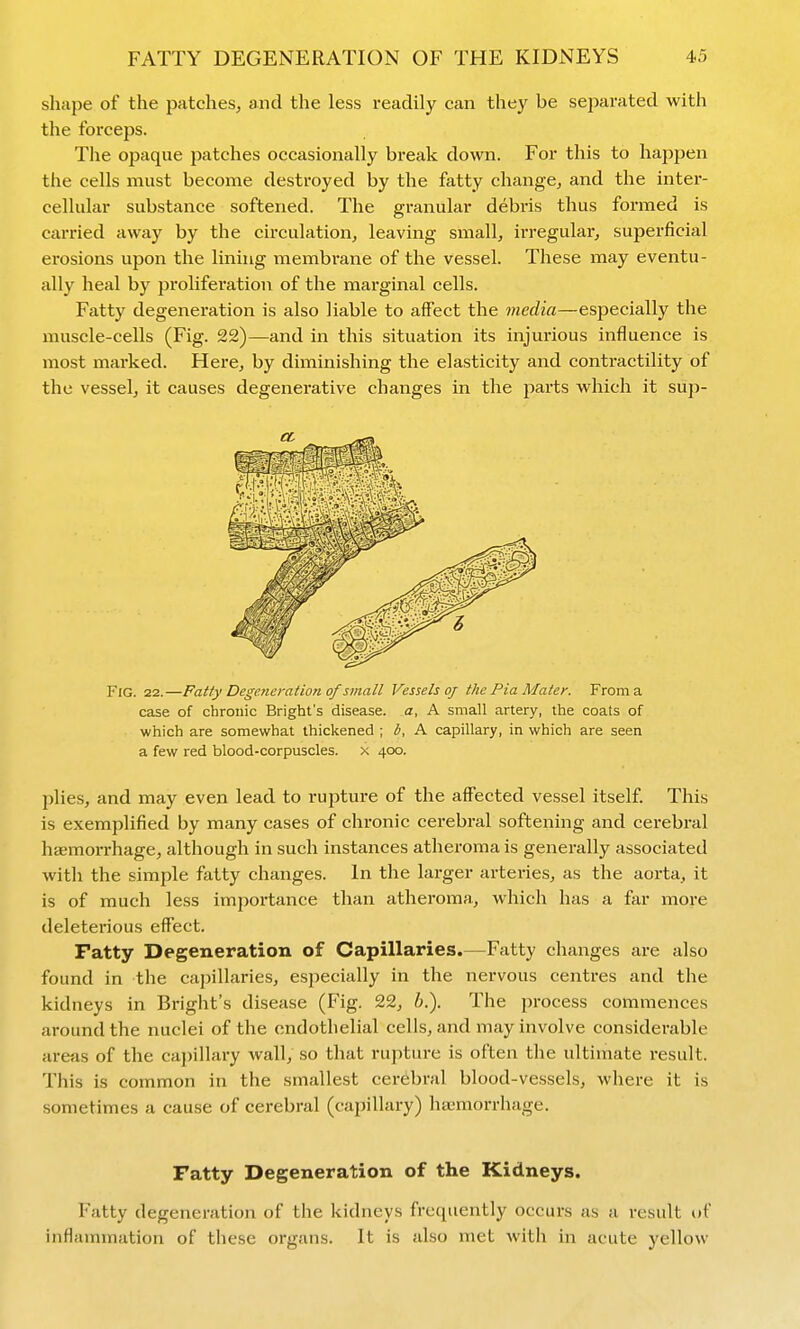 shape of the patches, and the less readily can they be separated with the forceps. The opaque patches occasionally break down. For this to happen the cells must become destroyed by the fatty change, and the inter- cellular substance softened. The granular debris thus formed is carried away by the circulation, leaving small, irregular, superficial erosions upon the lining membrane of the vessel. These may eventu- ally heal by proliferation of the marginal cells. Fatty degeneration is also liable to affect the media—especially the muscle-cells (Fig. 22)—and in this situation its injurious influence is most marked. Here, by diminishing the elasticity and contractility of the vessel, it causes degenerative changes in the parts which it sup- FiG. 22.—Fatty Degeneration of small Vessels of the Pia Mater. From a case of chronic Bright's disease, a, A small artery, the coats of which are somewhat thickened ; i, A capillary, in which are seen a few red blood-corpuscles, x 400. plies, and may even lead to rupture of the affected vessel itself. This is exemplified by many cases of chronic cerebral softening and cerebral haemorrhage, although in such instances atheroma is generally associated with the simple fatty changes. In the larger arteries, as the aorta, it is of much less importance than atheroma, which has a far more deleterious effect. Fatty Degeneration of Capillaries.—Fatty changes are also found in the cajjillaries, especially in the nervous centres and the kidneys in Bright's disease (Fig. 22, h.). The process commences around the nuclei of the endothelial cells, and may involve considerable areas of the cajMllary wall, so that rupture is often the ultimate result. This is common in the smallest cerebral blood-vessels, where it is sometimes a cause of cerebral (capillary) haemorrhage. Fatty Degeneration of the Kidneys. Fatty degeneration of the kidneys frequently occurs as a result of inflammation of these organs. It is also met with in acute yellow