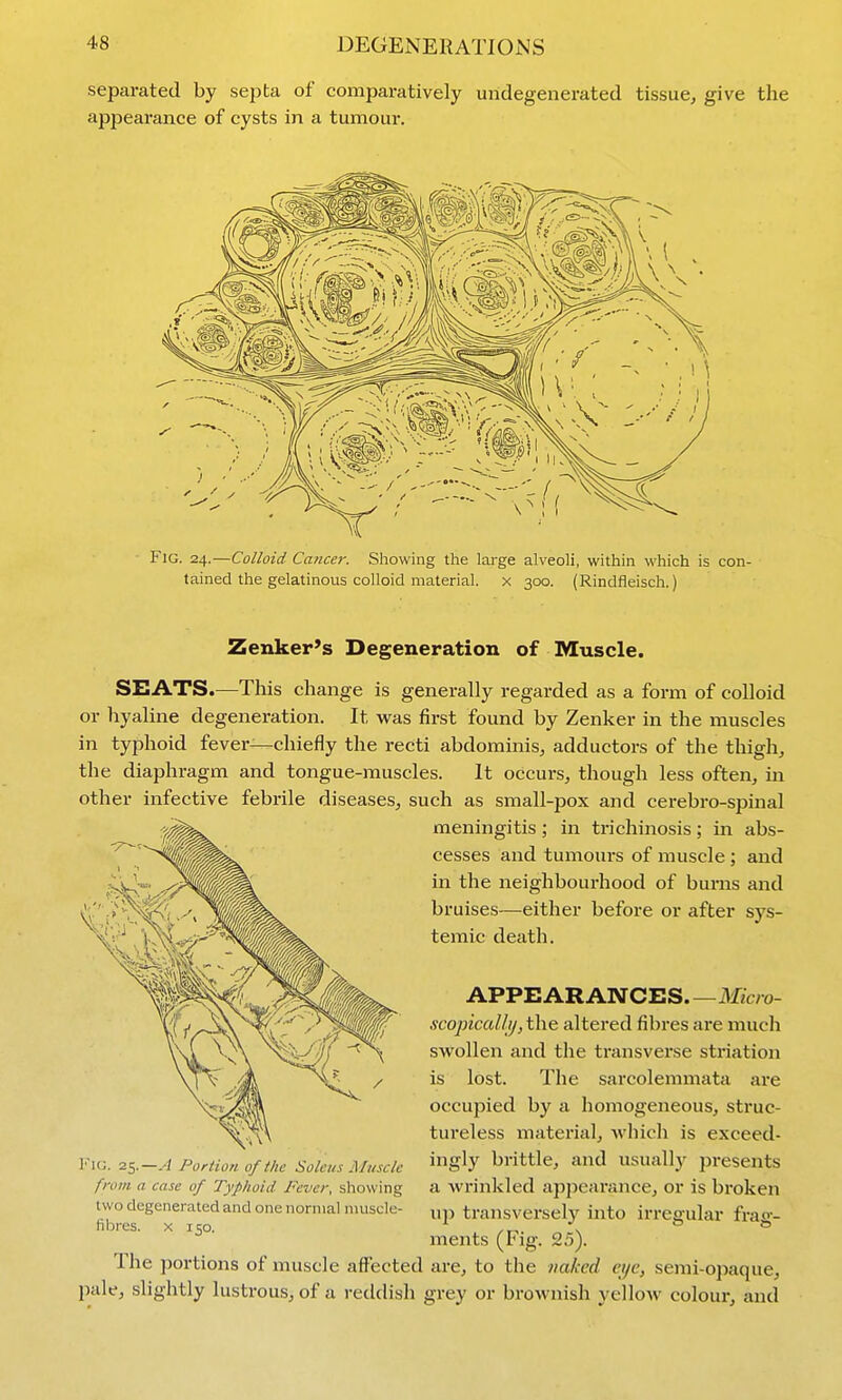 separated by septa of comparatively undegenerated tissue^ give the appearance of cysts in a tumour. Zenker's Degeneration of Muscle. SEATS.—This change is generally regarded as a form of colloid or hyaline degeneration. It was first found by Zenker in the muscles in typhoid fever—chiefly the recti abdominis, adductors of the thigh^ the diaphragm and tongue-muscles. It occurs, though less often, m other infective febrile diseases, such as small-pox and cerebro-spinal meningitis ; in trichinosis; in abs- cesses and tumours of muscle ; and in the neighbourhood of burns and bruises—either before or after sys- temic death. APPEARANCES Micro- scopiccdlij, the altered fibres are much swollen and the transverse striation is lost. The sarcolemmata are occupied by a homogeneous, struc- tureless material, which is exceed- ingly brittle, and usually presents a wrinkled appearance, or is broken up transversely into irregular frag- ments (Fig. 25). The portions of muscle aflPected are, to the naked eye, semi-opaque, pale, slightly lustrous, of a reddish grey or brownish yellow colour, and V\v.. 2S.—.4 Portion of the Sokus Muscle from a case of Typhoid Fever, showing two degenerated and one normal muscle- fibres. X 150.
