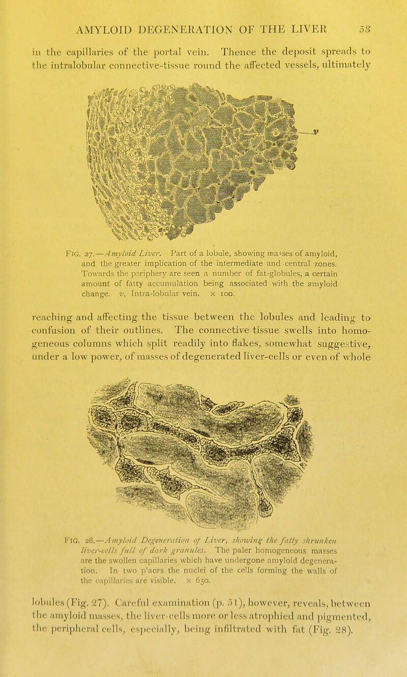 in the capillaries of the portal vein. Thence the deposit spreads to the intralobular connective-tissue round the affected vessels^ ultimately Frc. 27. — Amyloid Liver. Part of a lobule, showing masses of amyloid, and the greater implication of the intermediate and central zones. Towards the psripher}' are seen a number of fat-globules, a certain amount of fatty accumulation being associated with the amyloid change, v, Intra-lobular vein, x 100. reaching and affecting the tissue between the lobules and leading to confusion of their outlines. The connective tissue swells into homo- geneous columns which split readily into flakes^ somewhat suggestive, under a low jiower, of masses of degenerated liver-cells or even of Avhole Fig. 28.—Amyloid Degeneration of Liver, shoxuiiig the fatly shrunken liver-cells full of dark granides. The paler homogeneous masses are the swollen capillaries which have undergone amyloid degenera- tion. In two p'aces the nuclei of the cells forming the walls of the c;ipiliarics are visible, x 650. lobules (Fig. 27). Careful examination (p. .il), however, reveals, between the amyloid masses, the liver-cells more or less atrophied and pigmented, the i)eriphcral cells, especially, being infiltrated with fat (Fig. 28).