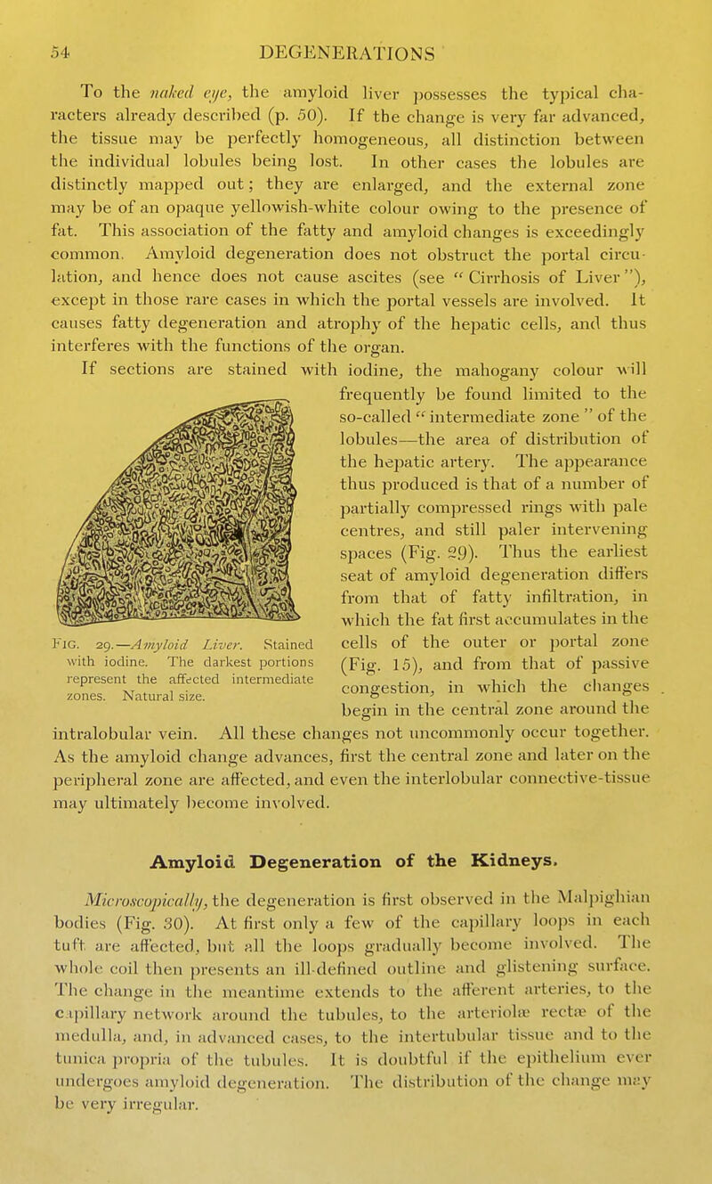 To the linked cijc, the amyloid liver possesses the typical cha- racters already descri])ed (p. 50). If the change is very far advanced, the tissue may be perfectly homogeneous, all distinction between the individual lobules being lost. In other cases the lobules are distinctly mapped out; they are enlarged, and the external zone may be of an opaque yellowish-white colour owing to the presence of fat. This association of the fatty and amyloid changes is exceedingly common. Amyloid degeneration does not obstruct the portal circu- lation, and hence does not cause ascites (see  Cirrhosis of Liver), except in those rare cases in which the portal vessels are involved. It causes fatty degeneration and atrophy of the hepatic cells, and thus interferes with the functions of the or<ran. o If sections are stained with iodine, the mahogany colour will frequently be found limited to the so-called  intermediate zone  of the lobules—the area of distribution of the hejiatic artery. The appearance thus produced is that of a number of partially com23ressed rings with pale centres, and still paler intervening spaces (Fig. 29). Thus the earliest seat of amyloid degeneration differs from that of fatty infiltration, in which the fat first accumulates in the cells of the outer or 2)ortal zone (Fig. 15), and from that of passive congestion, in which the changes beg-in in the central zone around the intralobular vein. All these changes not imcommonly occur together. As the amyloid change advances, first the central zone and later on the peripheral zone are affected, and even the interlobular connective-tissue may ultimately become involved. Amyloid Degeneration of the Kidneys. Microscopical 11/, the degeneration is first observed in the Malpighian bodies (Fig. 30). At first only a few of the capillary loops in each tuft are affected, but all tlie loops gradually become involved. The whoU: coil then presents an ill-defined outline and glistening surface. The cliange in tlie meantime extends to the afferent arteries, to the c.ipillary network around the tubules, to the arteriole rectae of the medulla, and, in advanced cases, to the intertubular tissue and to the tunica propri.n of the tubules. It is doubtful if the epithelium ever undergoes amyloid degeneration. The distribution of the change may be very irregidar. Fig. 29.—Amyloid Liver. Stained with iodine. The darkest portions represent the affected intermediate zones. Natural size.