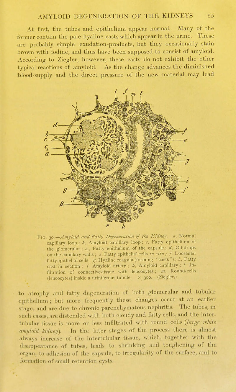 At first, the tubes and epithelium appear normal. Many of the former contain the pale hyalme casts which appear in the m-ine. These iire probably simple exudation-products, but they occasionally stain brown with iodine, and thus have been supjiosed to consist of amyloid. According- to Ziegler, however, these casts do not exhibit the other tyjncal reactions of amyloid. As the change advances the diminished blood-sup2>ly and the direct pressure of the new material may lead ^ k Fig. ^o.—Amyloid and Fatly Degeneration of ike Kidney, a, Normal capillary loop ; b, Amyloid capillary loop ; c. Fatty epithelium of the glomerulus; c,, Fatty epithelium of the capsule ; d, Oil-drops on the capillary walls ; e. Fatty epithelial cells in situ.; /, Loosened fattyepithelial cells ; g, Hyaline coagula (forming  casts ) ; //, Fatty cast in section ; i, Amyloid artery ; k, Amyloid capillary ; /, In- filtration of connective-tissue with leucocytes; m. Rounci-cells (leucocytes) inside a uriniferous tubule, x 300. (Ziegler.) to atrophy and fatty degeneration of both gloiTierular and tubular epitlielium ; but more frequently these clianges occur at an earlier stage, and are due to chronic parenchymatous nephritis. The tubes, in sucli cases, are distended with both cloudy and fatty cells, and the inter- tubular tissue is more or less infiltrated with round cells {large white amijloid Iddneij). In the later stages of the jjroccss there is almost always increase of the intertubular tissue, whicli, together with the disapj)earance of tubes, leads to shrinking and toughening of the ■organ, to adhesion of the capsule, to irregularity of the surface, and to formation of small retention cysts.