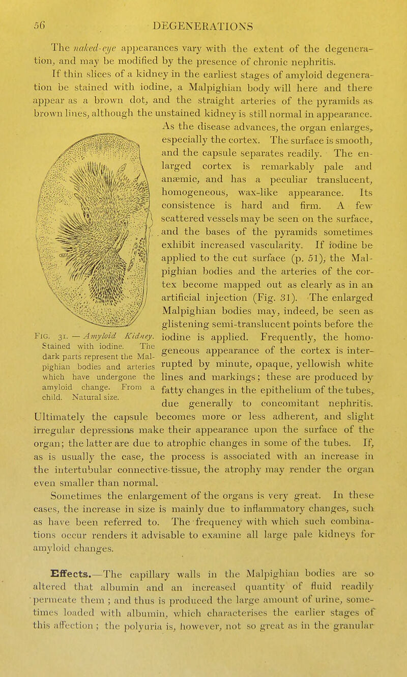 The nakcd-cijc appearances varj' with the extent of the degenera- tion, and may be modified by the presence of chronic nephritis. If thin slices of a kidney in the earliest stages of amyloid degenera- tion be stained with iodine, a Malpighian body will here and there apjjear as a brown dot, and the straight arteries of the pyramids as brown lines, although the unstained kidney is still normal in appearance. As the disease advances, the organ enlarges, especially the cortex. The surface is smooth, and the capsule separates readily. The en- larged cortex is remarkably pale and anaemic, and has a peculiar translucent, homogeneous, wax-like apjjearance. Its consistence is hard and firm. A few scattered vessels may be seen on the surface, and the bases of the pyramids sometimes exhibit increased vascularity. If iodine be applied to the cut surface (p. 51), the Mal- pighian bodies and the arteries of the cor- tex become mapped out as clearly as in an artificial injection (Fig. 31). The enlarged Malpighian bodies maj-, indeed, be seen as glistening semi-transhicent points befoi-e the iodine is applied. Frequently, the homo- geneous appearance of the cortex is mter- rupted by mmute, ojjaque, yellowish white lines and markings; these are produced by fatty changes in the epithelium of the tubes, due generally to concomitant nephritis. Ultimately the capsule becomes more or less adherent, and slight irregular dejiressions make their appearance upon the surface of the organ; the latter are due to atrophic changes in some of the tubes. If, as is usually the case, the process is associated with an increase in the intertubular connective-tissue, the atrophy may render tlie organ even smaller than normal. Sometimes the enlargement of the organs is verj^ great. In these cases, the increase in size is mainly due to inflammatory changes, such as have been referred to. The frequency with which such combina- tions occur renders it advisable to examine all large pale kidnej's for arayloid changes. Effects.—The capillary walls in the Malpighian bodies are so altered that albumin and an increasetl quantity of fluid readily ■permeate them ; and thus is produced the large amount of urine, some- times loaded with albumin, v.'hich characterises the earlier stages of this affection ; the polyuria is, however, not so great as in the granular Fig. 31. — Amyloid Kidney. Stained withi iodine. The darlc parts represent the Mal- pighian bodies and arteries which have undergone the amyloid change. From a child. Natural size.