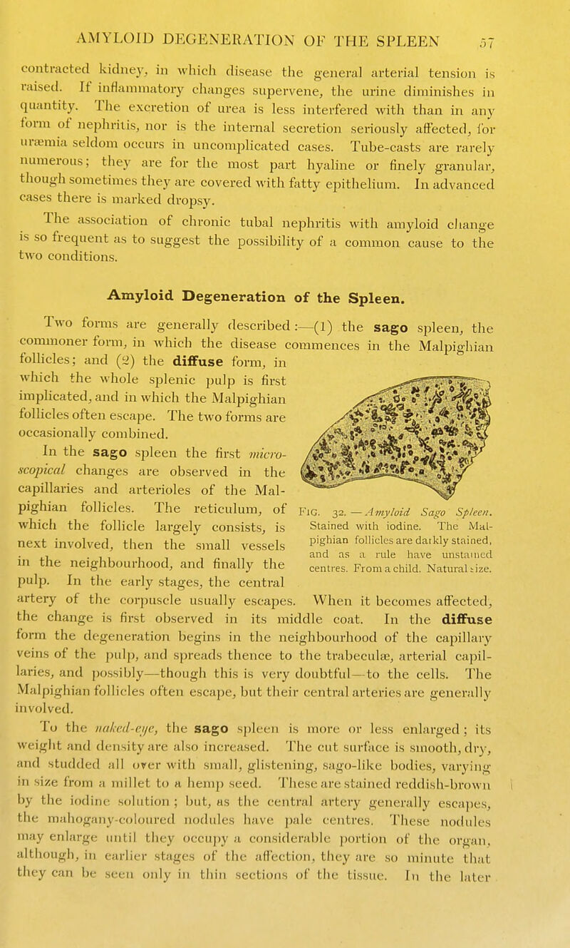 contracted kidney, in which disease the general arterial tension is raised. If inflammatory changes supervene, the urine diminishes in quantity. The excretion of urea is less interfered with than in any form of nephritis, nor is the internal secretion seriously affected, for uraemia seldom occurs in uncomjilicated cases. Tube-casts are rarely numerous; they are for the most part hyaline or finely granular, though sometimes they are covered with fatty epithelium. In advanced cases there is marked dropsy. The association of chronic tubal nephritis with amyloid change is so frequent as to suggest the possibility of a common cause to the two conditions. Amyloid Degeneration of the Spleen. Two forms are generally described :—(l) the sago spleen, the commoner form, in which the disease commences in the Malpighian follicles; and (2) the diffuse form, in which the whole splenic pulp is first impUcated, and in which the Malpighian follicles often escape. The two forms are occasionally combined. In the sago spleen the first 7mc7v- scapical changes are observed in the capillaries and arterioles of the Mal- pighian follicles. The reticulum, of which the follicle largely consists, is next involved, then the small vessels in the neighbourhood, and finally the pulp. In the early stages, the central artery of the corpuscle usually escapes. When it becomes affected, the change is first observed in its middle coat. In the diffuse form the degeneration begins in the neighbourhood of the capillary veins of the pulp, and spreads thence to the trabeculaj, arterial capil- laries, and possibly—thougii this is very doubtful—to the cells. The Malpighian follicles often escape, but their central arteries are generally involved. To the tuded-ei/c, the sago spleen is more or less enlarged ; its weight and density are also increased. The cut surface is smooth, dry, and studded all over with small, glistening, sago-like bodies, varying in size from a millet to a hemp seed. These are stained reddish-brown i by the iodine solution ; but, as the central artery generally escapes, the mahogany-coloured nodules have pale centres. These nodules may enlarge until they occupy a considerable jjortion of the organ, although, in earlier stages of the affection, they are so minute that they can be seen only in thin sections of the tissue. In the later Fig. 32. —Amyloid Sago Spleen. Stained with iodine. The Mal- pighian follicles are datkly stained, and as a rule have unstained centres. From a child. Natural tize.