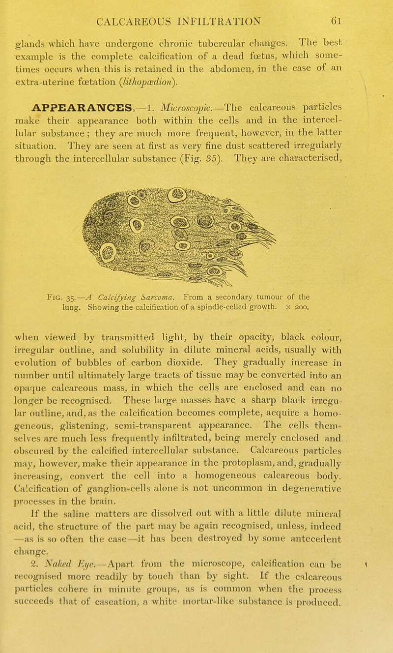 glands which have undergone chronic tubercular changes. The best example is the complete calcification of a dead fcetus, which some- times occurs when this is retained in the abdomen^ in the case of an extra-uterine fcetation Qithopcedioit). APPEARANCES,—1. Microscopic.—The calcareous particles make their appearance botli within the cells and in the intercel- lular substance; they are much more frequent, however, in the latter situation. They are seen at first as very fine dust scattered irregularly through the intercellular substance (Fig. 35). They are chai-acterised, Fig. 35.—A Calcifying Sarcoma. From a secondary tumour of the lung. Showing the calcification of a spindle-celled growth, x 200. when viewed by transmitted light, by their opacity, black colour, irregular outline, and solubility in dilute mineral acids, usually with evolution of bubbles of carbon dioxide. They gradually increase in number until ultimately large tracts of tissue may be converted into an oparjue calcai'eous mass, in which the cells are enclosed and fean no longer be recognised. These large masses have a sharp black irregu- lar outline, and, as the calcification becomes complete, acquire a homo- geneous, glistening, semi-transparent appearance. The cells them- selves are much less frequently infiltrated, being merely enclosed and obscured by the calcified intercellular substance. Calcareous particles may, however, make their appearance in the protoplasm, and, gradually increasing, convert the cell into a homogeneous calcareous bod}'. Calcification of ganglion-cells alone is not uncommon in degenerative I)rocesses in the brain. If the saline matters are dissolved out with a little dilute mineral acid, the structure of the part may be again recognised, unless, indeed —as is so often the case—it has been destroyed by some antecedent change. 2. Naked Eye.—Apart from the microscope, calcification can be < recognised more readily by touch than by sight. If the calcareous j)articles cohere in minute groups, as is common when the process succeeds that of caseation, a white mortar-like substance is jiroduced.