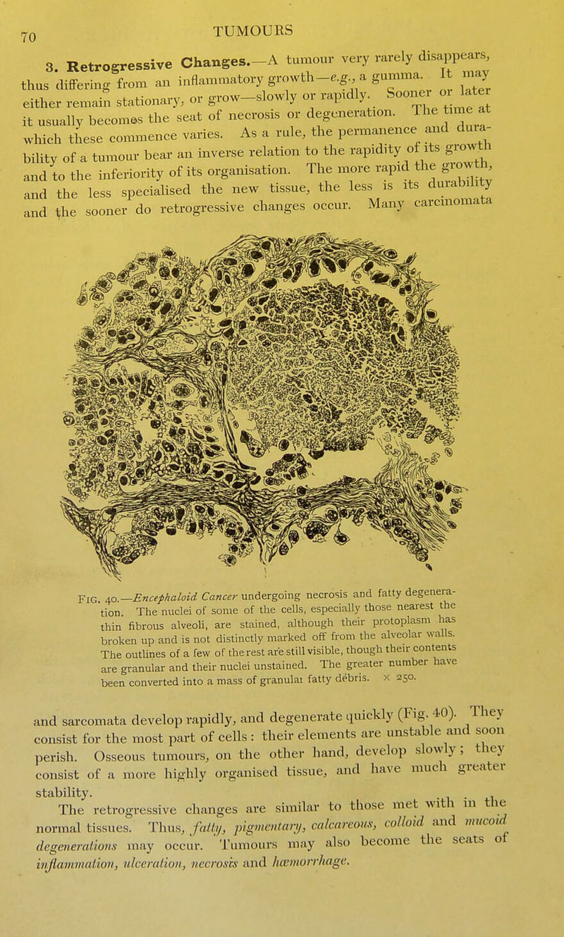 3. Retrogressive Changes.-A tumour very rarely disappears thus difFering from an inflammatory growth-e.g a gumma I may either remain stationary, or grow-slowly or rap.dly Soozoe ox late it usually becomes the seat of necrosis or degeneration. Tl ^ xme at which these commence varies. As a rule, the permanence and dma^ bihty of a tumour bear an inverse relation to the rapidity of its growth and to the inferiority of its organisation. The more rapid the grow h and the less speciaHsed the new tissue, the less is its durability and ifhe sooner do retrogressive changes occur. Many carcmomata Fig 40 —Encefhaloid Cancer undergoing necrosis and fatty degenera- tion The nuclei of some of the cells, especially those nearest the thin fibrous alveoh, are stained, although their protoplasm has broken up and is not distinctly marked off from the alveolar walls. The outUnes of a few of therest are still visible, though their contents are granular and their nuclei unstained. The greater number have been converted into a mass of granulai fatty debris, x 250. and sarcomata develop rapidly, and degenerate quickly (Fig. 40). They consist for the most part of cells : their elements are unstable and soon perish. Osseous tumours, on the other hand, develop slowly; they consist of a more highly organised tissue, and have much greater stability. . The retrogressive changes are similar to those met with in the normal tissues. Thus, fallij, ingvicntary, calcareous, colloid and mucoid degmerations may occur. 'Tumours may also become the seats of inflammation, ulceration, necrosis and haimorrhage.