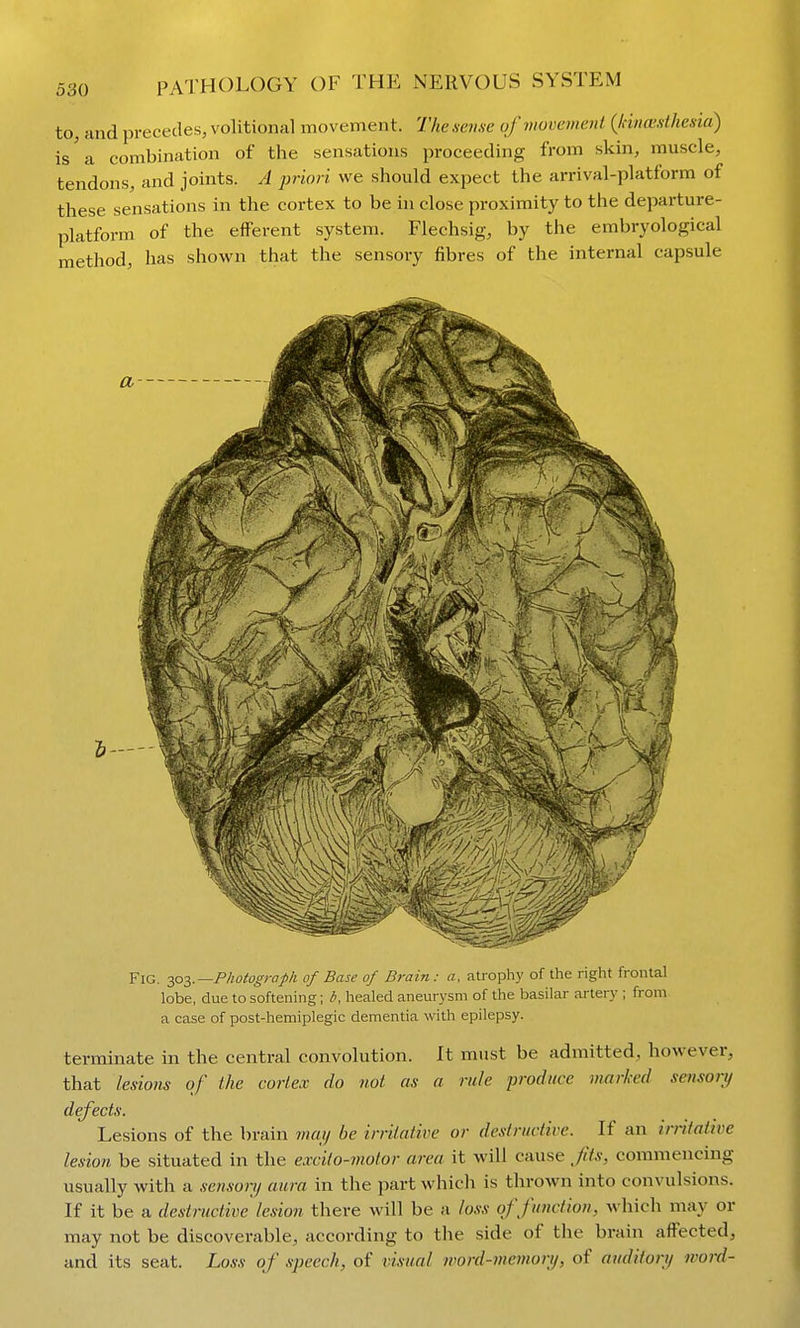 to, find precedes, volitional movement. The seme of movement (JcmcBsthesia) is a combination of the sensations proceeding from skin, muscle, tendons, and joints. A priori we should expect the arrival-platform of these sensations in the cortex to be in close proximity to the departure- platform of the efferent system. Flechsig, by the embryological method, has shown that the sensory fibres of the internal capsule Fig. jpz-—Photograph of Base of Brain: a, atrophy of the right frontal lobe, due to softening; b, healed aneurysm of the basilar artery ; from a case of post-hemiplegic dementia with epilepsy. terminate in the central convolution. It must be admitted, however, that lesions of the cortex do not as a rule produce marked sensory defects. Lesions of the brain viaii be irriiative or destructive. If an irritative lesion be situated in the excilo-motor area it will cause Jits, commencing usually with a sensorij aura in the part which is throAvn into convulsions. If it be a destructive lesion there will be a loss of function, which may or may not be discoverable, according to the side of the brain affected, and its seat. Loss of speech, of visual word-memortj, of auditory word-