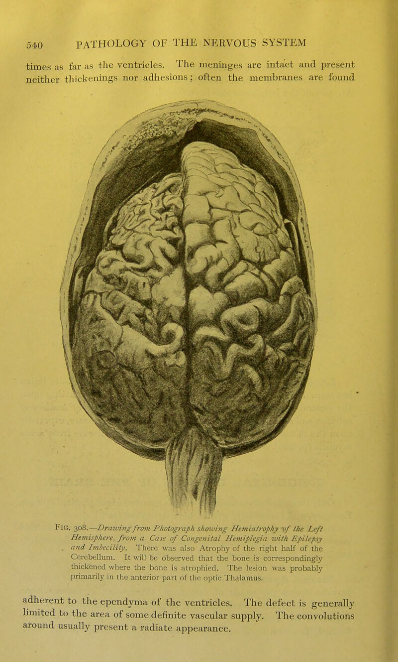 times as far as the ventricles. The meninges are intact and present neither thickenings nor adlicsions; often the membranes are found Fig. 308.—Drawing from Photograph showing Hemiatrophy vf tlw Left Hemisphere, from a Case of Congenital Hemiplegia 7oith Epilepsy . and Imbecility. There was also Atrophy of the right half of the Cerebellum. It will be observed that the bone is correspondinglj' thickened where the bone is atrophied. The lesion was probablj' primarily in the anterior part of the optic Thalamus. adherent to the ependyma of the ventricles. The defect is generally limited to the area of some definite vascular supply. The convolutions around usually present a radiate appearance.