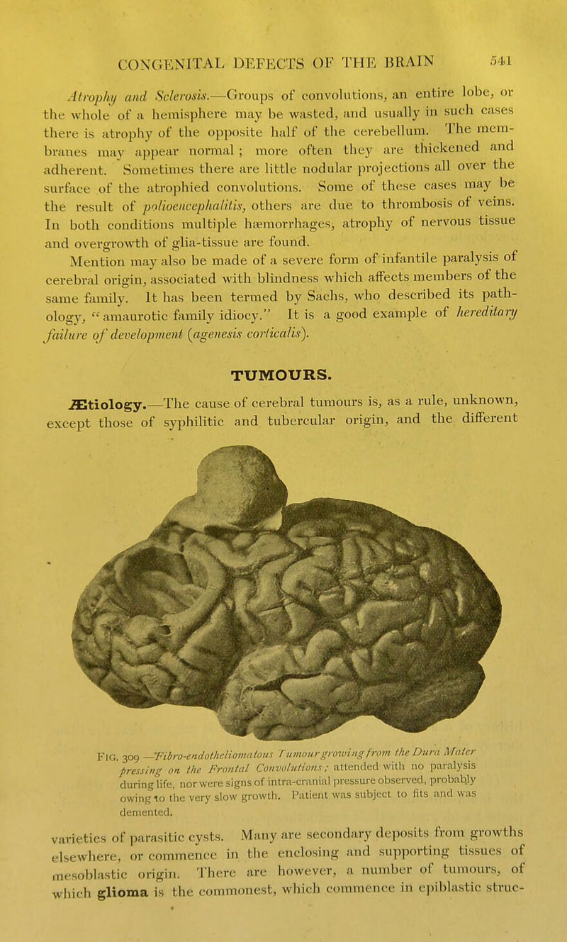Alrophij and Sclerosis:—Groups of convolutions, an entire lobe, or the whole of a hemisphere may be wasted, and usually in such cases there is atrophy of the opposite half of the cerebellum. The mem- branes may appear normal ; more often they are thickened and adherent. Sometimes there are little nodular projections all over the surface of the atrophied convolutions. Some of these cases may be the result of polioencephalitis, others are due to thrombosis of veins. In both conditions multiple haemorrhages, atrophy of nervous tissue and overgrowth of glia-tissue are found. Mention may also be made of a severe form of infantile paralysis of cerebral origin, associated with blindness which aifects members of the same family. It has been termed by Sachs, who described its path- ology, amaurotic family idiocy. It is a good example of hereditary failure of development {agenesis corlicalis). TUMOURS. .Sltiology.—The cause of cerebral tumours is, as a rule, unknown, except those of syphilitic and tubercular origin, and the different Fig. 309 —Fibro-endotheliomatous Tumour growing from tlie Dura Maicr pressing on. the Frontal Convolutions; attended with no paralysis during life, nor were signs of intra-cranial pressure observed, probab.ly owing to the very slow growth. Patient was subject to fits and was demented. varieties of parasitic cysts. iMany are secondary deposits from growths elsewhere, or commence in tlie enclosing and supporting tissues of mesoblastic origin. There are however, a number of tumours, of which glioma is the commonest, which commence in epiblastic struc-