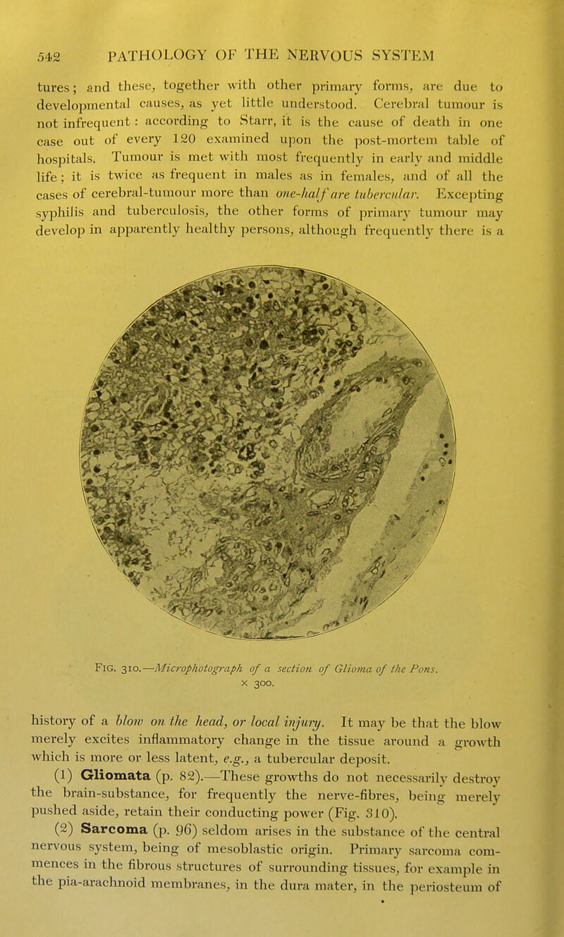 tures; and these, together with other primary forms, are due to developmental causes, as yet little understood. Cerebral tumour is not infrequent : according to Starr, it is the cause of death in one case out of every 120 examined upon the post-mortem table of hospitals. Tumour is met with most frequently in early and middle life; it is twice as frequent in males as in females, and of all the cases of cerebral-tumour more than one-half are tubercular. Exce{)ting syphilis and tuberculosis, the other forms of primary tumour may develop in apparently healthy persons, although frequently there is a Fig. 310.—Mia-ophotograpk of a section of Glioma of the Pons. X 300. history of a blow on the head, or local injunj. It may be that the blow merely excites inflammatory change in the tissue around a growth which is more or less latent, e.g., a tubercular deposit. (1) Gliomata (p. 82).—These growths do not necessarily destroy the brain-substance, for frequently the nerve-fibres, being merely pushed aside, retain their conducting power (Fig. 310). (2) Sarcoma (p. 96) seldom arises in the substance of the central nervous system, being of mesoblastic origin. Primary sarcoma com- mences in the fibrous structures of surrounding tissues, for example in the pia-arachnoid membranes, in the dura mater, in the periosteum of