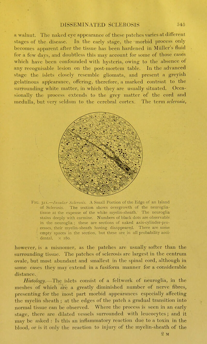 a walnut. The naked eye appearance of these patches varies at different stages of the disease. In the early stage, the morbid process only becomes apparent after the tissue has been hardened in Miiller's fluid for a few days, and doubtless this may account for some of those cases which have been confounded with hysteria, owing to the absence of any recognisable lesion on the post-mortem table. In the advanced stage the islets closely resemble gliomata, and present a greyish gelatinous appearance, offering, therefore, a marked contrast to the suiTounding white matter, in which they are usually situated. Occa- sionally the process extends to the grey matter of the cord and medulla, but very seldom to the cerebral cortex. The term sclerosis, Fig. 31 t.—lusular Sclerosis. A Small Portion of the Edge of an Island of Sclerosis. The section shows overgrowth of the neuroglia- tissiie at the expense of the white myelin-sheath. The neuroglia stains deeply with carmine. Numbers of black dots are observable in the neuroglia ; these are sections of naked a.\is-cylinder-pro- cesses, their myelin-sheath having disappeared. There are some ■ empty spaces in the section, but these are in all probability acci- ' dental. x 180. however, is a misnomer, as the patches are usually softer than the surrounding tissue. The patches of sclerosis are largest in the centrum ovale, but most abundant and smallest in the spinal cord, although in some cases they may extend in a fusiform manner for a considerable distance. Histologij.—The islets consist of a feltw^ork of neuroglia, in the meshes of which are a greatly diminished number of nerve fibres, presenting for the inost pai-t moi-bid appearances especially affecting the myelin sheath ; at the edges of the patch a gradual transition into normal tissue can be observed. Where the process is seen in an early stage, there are dilated vessels surrounded with leucocytes ; and it may be asked : Is this an inflammatory i-eaction due to a toxin in the blood, or is it only the reaction to injury of the myelin-sheath of the 2 M