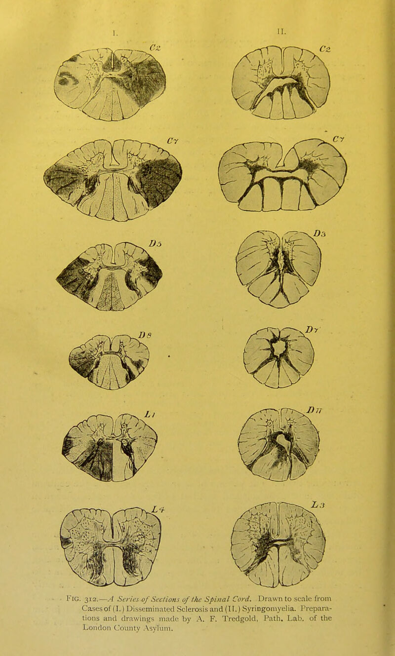 II. Fig. 312.—A i'tv/fj of Sec/ions of the Spinal Cord. Drawn to scale from Casesof (I.) Disseminated Scleiosisand (II.) Syringomyelia. Prepara- tions and drawings made by A. F. Trcdgold, Path. Lab. of the London County .\syluni.