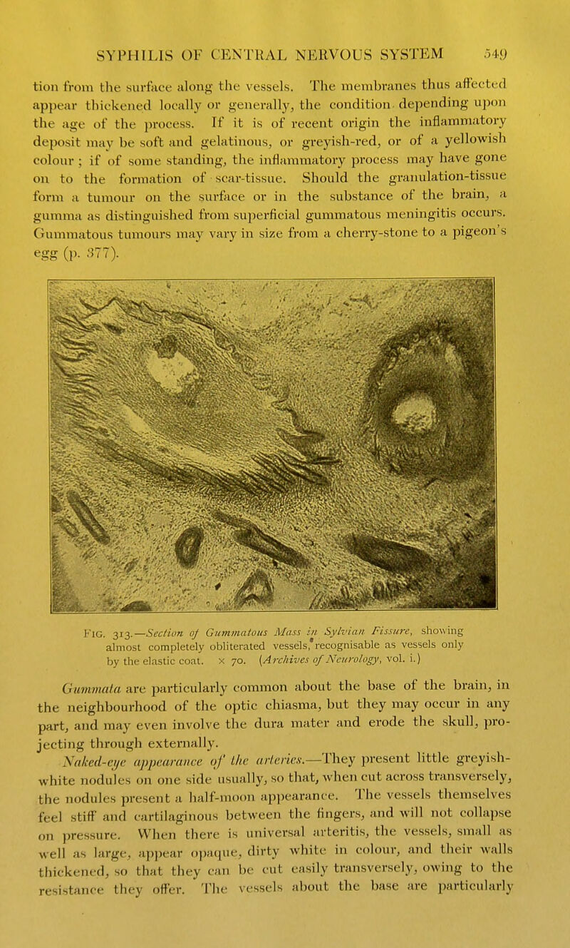 tion from the surface along the vessels. The membranes thus affected appear thickeneid locally or generally, the condition, depending ujion the age of the process. If it is of recent origin the inflammatory deposit may be soft and gelatinous, or greyish-red, or of a yellowish colour; if of some standing, the inflammatory process may have gone on to the formation of scar-tissue. Should the granulation-tissue form a tumour on the surface or in the substance of the brain, a gumma as distinguished from superficial gummatous meningitis occurs. Gummatous tumours may vary in size from a cherry-stone to a pigeon s egg (p. Sll). l-'iG. 313.—Sec/ion o] Gummatous Mass in Sylvian Fissure, showing almost completely obliterated vessels'recognisable as vessels only by the elastic coat, x 70. (Archives of Neurology, vol. i.) Gummata are particularly common about the base of the brain, in the neighbourhood of the optic chiasma, but they may occur in any part, and may even involve the dura mater and erode the skull, pro- jecting through externally. Naked-cifc appearance of Lite aiienes.—Y\\&y present little greyish- white nodules on one side usually, so that, when cut across transversely, the nodules present a half-moon api)earance. The vessels themselves feel stiff and cartilaginous between the fingers, and will not collapse on pressure. When there is universal arteritis, the vessels, small as well as large, appear ojjaque, dirty white in colour, and their walls thickened, so that they can be cut easily transversely, owing to the resistance they offer. Tlie vessels about the base are particularly