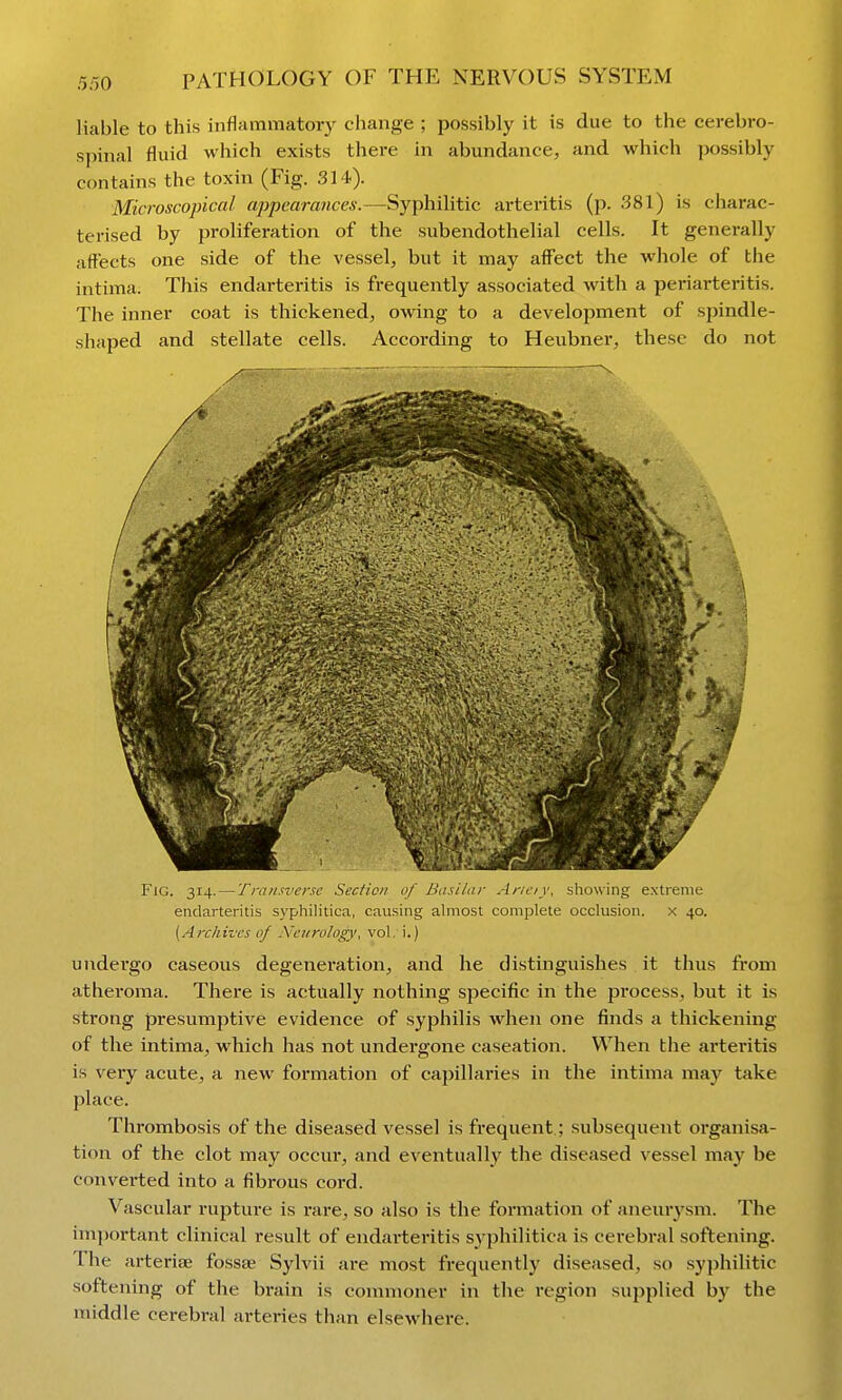 liable to this inflammatory change ; possibly it is due to the cerebro- spinal fluid which exists there in abundance, and which possibly contains the toxin (Fig. 314). Microscojncal aj)pearances.—Syphilitic arteritis (p. 381) is charac- terised by proliferation of the subendothelial cells. It generally affects one side of the vessel, but it may affect the whole of the intima. This endarteritis is frequently associated with a periarteritis. The inner coat is thickened, owing to a development of spindle- shaped and stellate cells. According to Heubner, these do not Fig. 314. — Transverse Secfici/ uf Basilar Aneiy, showing extreme endarteritis syphilitica, causing almost complete occlusion, x 40. [Archives of Ncjirology, vol. i.) undergo caseous degenei'ation, and he distinguishes it thus from athei'oma. There is actually nothing specific in the process, but it is strong presumptive evidence of syphilis when one finds a thickening of the intima, which has not undergone caseation. When the arteritis is very acute, a new formation of capillaries in the intima may take place. Thrombosis of the diseased vessel is frequent.; subsequent organisa- tion of the clot may occur, and eventually the diseased vessel may be converted into a fibrous cord. Vascular rupture is rare, so also is the formation of aneurysm. The important clinical result of endarteritis syphilitica is cerebral softening. The arterise fossae Sylvii are most frequently diseased, so syphilitic softening of the brain is commoner in the region supplied by the middle cerebral arteries than elsewhere.