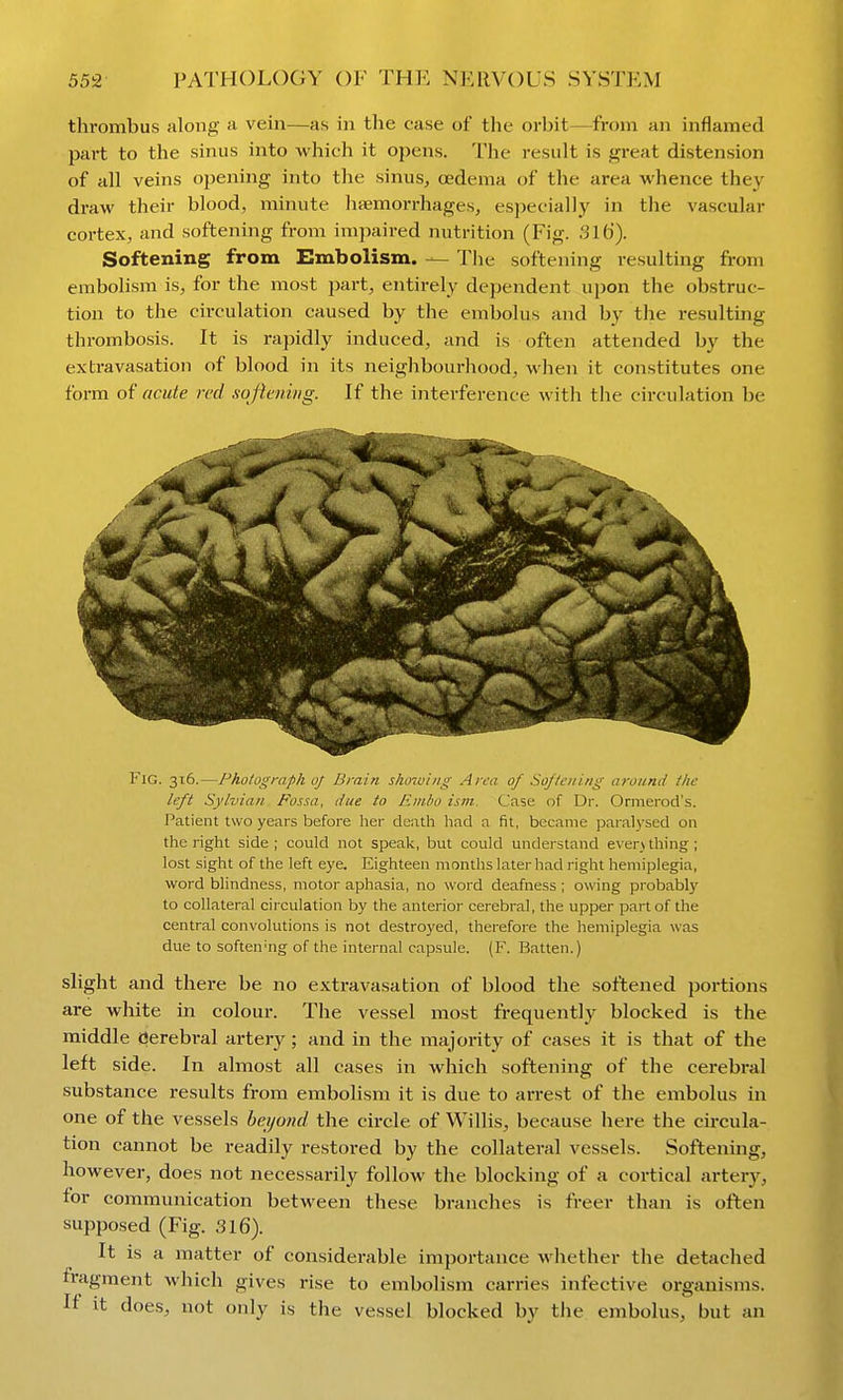 thrombus along a vein—as in the case of the orbit—from an inflamed part to the sinus into which it opens. The result is great distension of all veins opening into the sinus, oedema of the area whence they draw their blood, minute hfemorrhages, especially in the vascular cortex, and softening from impaired nutrition (Fig. 316). Softening from Embolism. — The softening resulting from embolism is, for the most part, entirely dependent upon the obstruc- tion to the circulation caused by the embolus and by the resulting thrombosis. It is rapidly induced, and is often attended by the extravasation of blood in its neighbourhood, when it constitutes one form of acute red sojieniiig. If the interference with the circulation be Fig. 316.—Photograph of Brain sho7viiig Area of Softening around the left Sylvian Fossa, due to Embo ism. Case of Dr. Ormerod's. Patient two years before her death had a fit, became paralj'sed on the right side; could not speak, but could understand everv thing; lost sight of the left eye. Eighteen months later had right hemiplegia, word blindness, motor aphasia, no word deafness ; owing probably to collateral circulation by the anterior cerebral, the upper part of the central convolutions is not destroyed, therefore the hemiplegia was due to soften'ng of the internal capsule. (F. Batten.) slight and there be no extravasation of blood the .softened portions are white in colour. The vessel most frequently blocked is the middle iJerebral arteiy ; and in the majority of cases it is that of the left side. In almost all cases in which softening of the cerebral substance results from embolism it is due to arrest of the embolus in one of the vessels beyond the circle of Willis, because here the circula- tion cannot be readily restored by the collateral vessels. Softening, however, does not necessarily follow the blocking of a cortical artery, for communication between these branches is freer than is often supposed (Fig. 316). It is a matter of considerable importance whether the detached fragment which gives rise to embolism carries infective organisms. If it does, not only is the vessel blocked by the embolus, but an