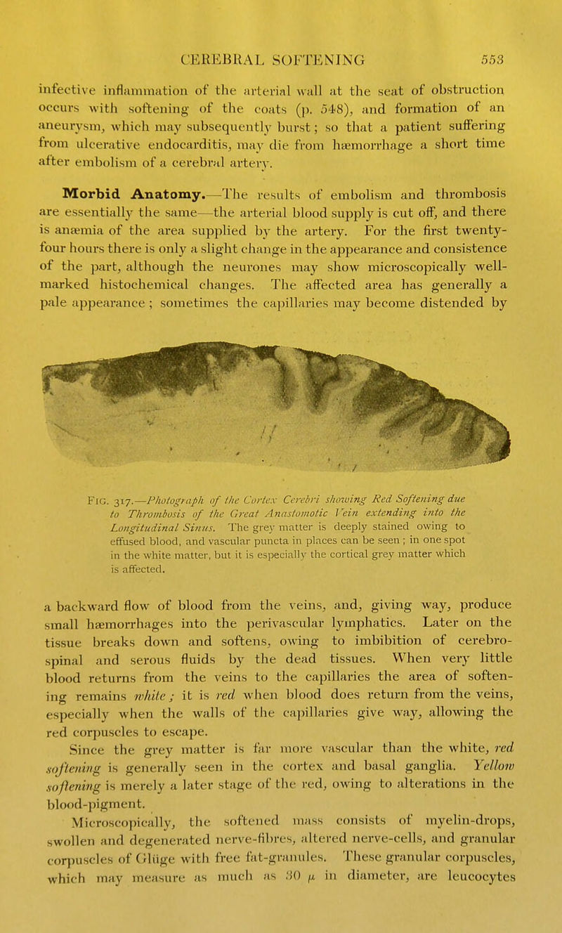 infective inflammation of the arterial wall at the seat of obstruction occurs with softening of the coats (p. 548), and formation of an aneurysm, which may subsequently burst; so that a patient suffering from ulcerative endocarditis, may die from haemorrhage a short time after embolism of a cerebral artery. Morbid Anatomy.—The results of embolism and thrombosis are essentially the same—the arterial blood supply is cut off, and there is ana?mia of the area supplied by the artery. For the first twenty- four hours there is only a slight change in the apjiearance and consistence of the part, although the neurones may show microscopically well- marked histochemical changes. The affected area has generally a pale appearance ; sometimes the capillaries may become distended by Fig. 317.—Photograph of the Cortex Cerebri shoiving Red Softening due to Thrombosis of the Great Anastomotic Vein extending into the Longitudinal. Sinus. The gi-e\- matter is deeply stained owing to effused blood, and vascular puncta in places can be seen ; in one spot in the white matter, but it is especially the cortical grey matter which is affected. a backward flow of blood from the veins, and, giving way, produce small haemorrhages into the perivascular lymjjhatics. Later on the tissue breaks down and softens, owing to imbibition of cerebro- spinal and serous fluids by the dead tissues. When very little blood returns from the veins to the capillaries the area of soften- ing remains white; it is red when blood does return from the veins, especially when the walls of the ca))illaries give way, allowing the red corpuscles to escape. Since the grey matter is far more vascular than the white, red softening is generally seen in the cortex and basal ganglia. Yellow snflening is merely a later stage of the red, owing to alterations in the blood-pigment. Microscopically, the softened mass consists of myelin-drops, swollen and degenerated nerve-fibres, altered nerve-cells, and granular corpuscles of Oliige with free fat-granules. These granular corpuscles, which may measure as much as .'JO jx in diameter, are leucocytes