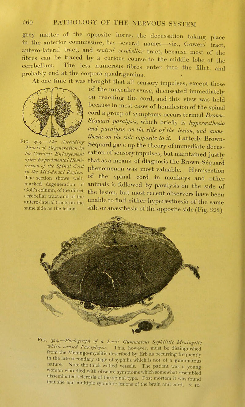grey matter of the op2io.site horns, the decussation taking place in the anterior commissure, has several names--viz., Gowers' tract, antero-lateral tract, and ventral cerebellar tract, because most of the fibres can be traced by a curious course to the middle lobe of the cerebellum. The less numerous fibres enter into the fillet, and probably end at the corpora quadrigemina. At one time it was thought tliat all sensory impulses, except those of the muscular sense, decussated immediately on reaching the cord, and this view was held because in most cases of hemilesion of the spinal cord a group of symptoms occurs termed Brown- Sequard paralysix, which briefly is hypera;sthesia and parakjsis on the side of the lesion, and aiices- ^, , i^^<^^('' on the side opposite to it. Latterh- Brown- tlG. 323. — I he Ascendin? cj .1 Tracts of Degeneration in ^^quard gave up the theory of immediate decus- ihe Cervical Enlargement sation of sensory impulses, but maintained justly after ExperimentalHemi- that as a means of diagnosis the Brown-Sequard section of the Spinal Cord va1-.£.„„™„ ^ i i, inthe Mid-dorsal Region. P^^enomenon was most valuable. Hemisection The section shows well- °^ spinal cord in monkeys and other marked degeneration of animals is followed by paralysis on the side of antero-lateral tracts on the able to find either hyperaesthesia of the same same side as the lesion. side or anaesthesia of the opposite side (Fig. 323). Fig. 32^.—Photograph of a Local Gummatous Syphilitic Meningitis which caused Paraplegia. This, howe\er, must be distinguished from the Meningo-myelitis described by Erb as occurring frequently in the late secondary stage of syphilis which is not of a gummatous nature. Note the thick \\'alled vessels. The patient was a young woman who died with obscure symptoms which somewhat resembled dissemmated sclerosis of the spinal type. Post mortem it was found that she had multiple syphilitic lesions of the brain and cord, x 10.