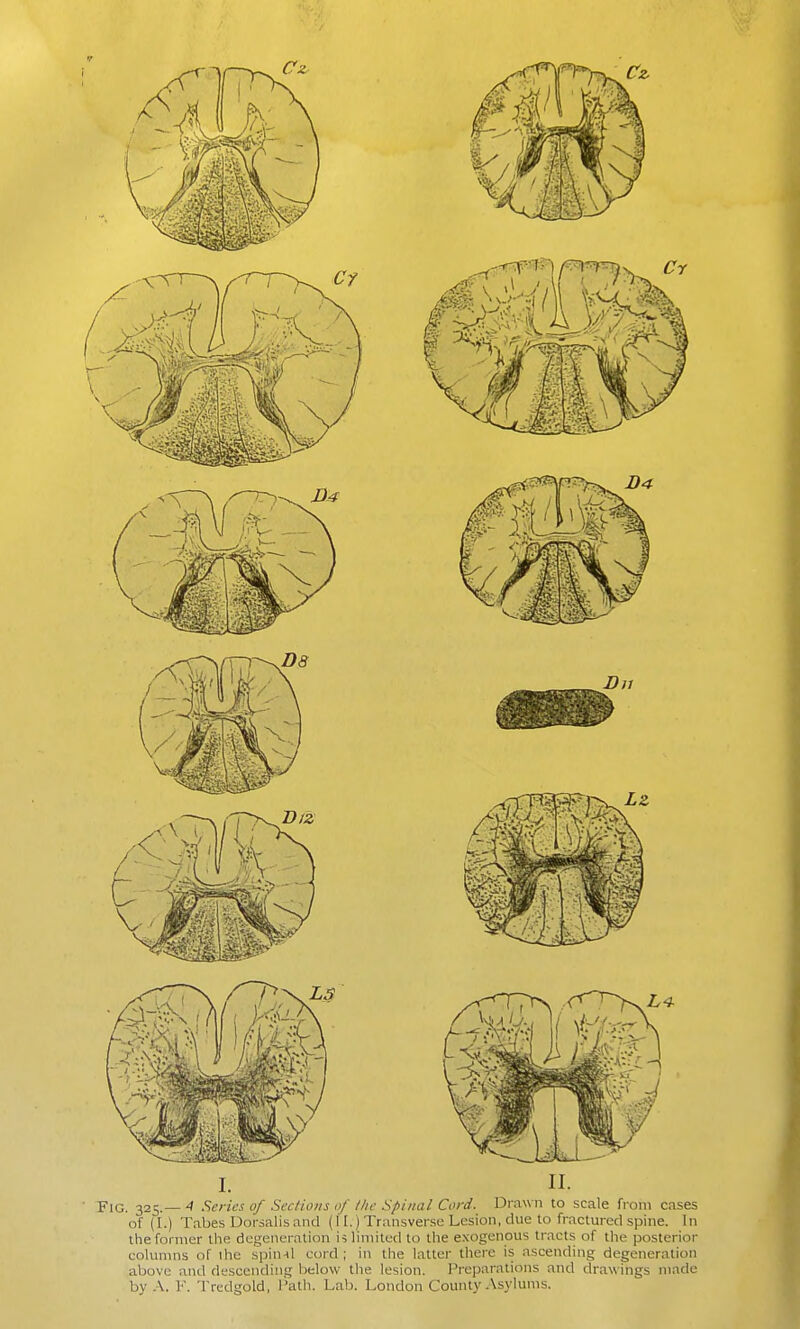 Fig. 325.— 4 Scries of Sections of tlie Spinal Cord. Drawn to scale from cases of (I.) Tabes Dorsalisand (11.) Transverse Lesion, clue to fractured spine. In lheforn\er the degeneration is limited to the exogenous tracts of the posterior colunuis of ihc spinil cord ; in the latter there is ascending degeneration above and descending below the lesion. Preparations and drawings made by A. I'. Tredgold, I'atli. Lab. London County Asylums.